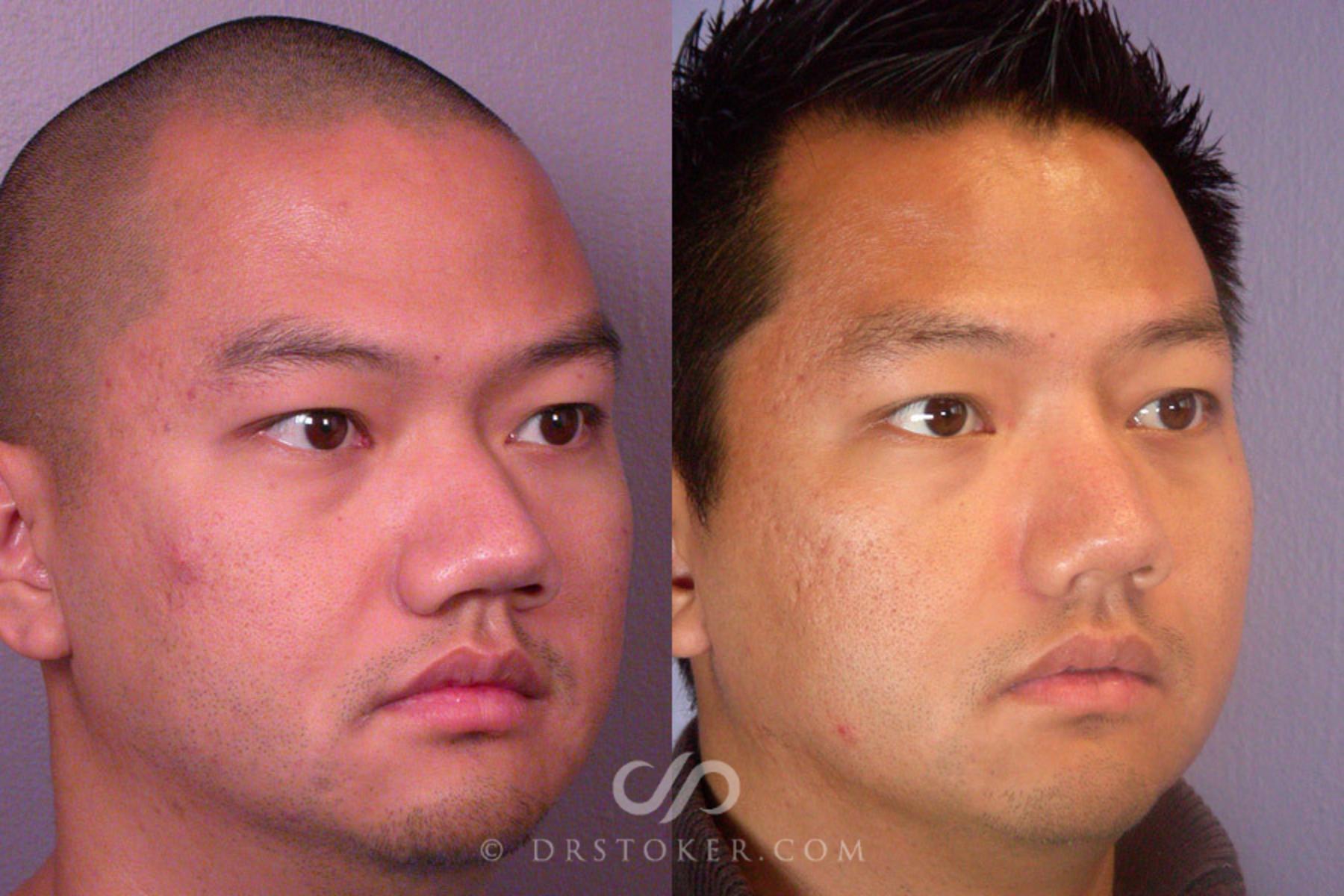 Before & After Rhinoplasty Case 275 View #2 View in Los Angeles, CA