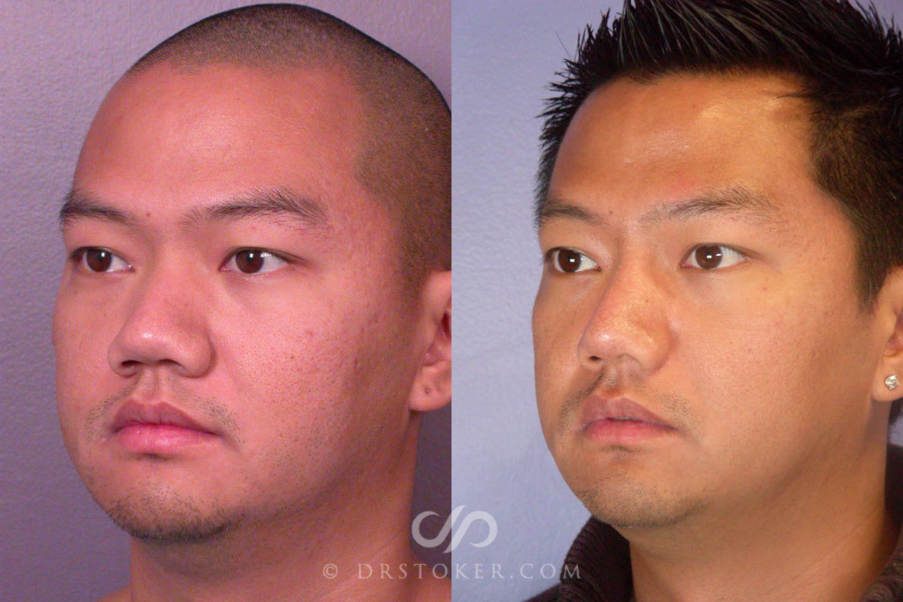 Before & After Rhinoplasty Case 275 View #3 View in Los Angeles, CA