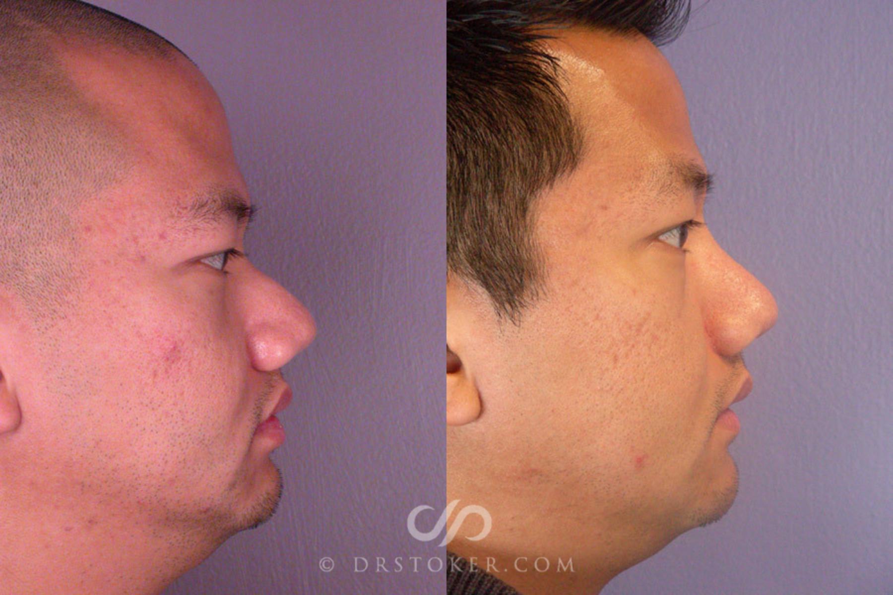 Before & After Rhinoplasty Case 275 View #4 View in Los Angeles, CA