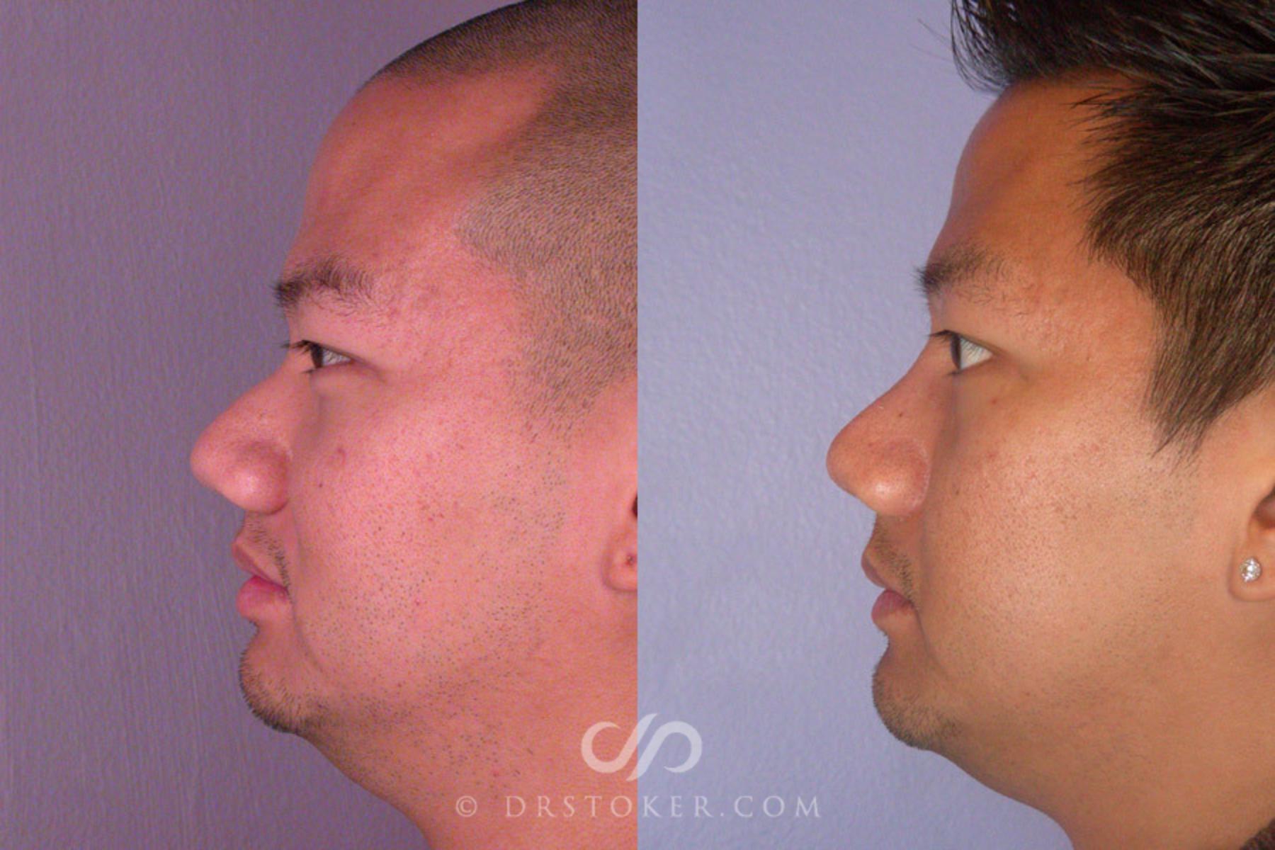 Before & After Rhinoplasty Case 275 View #5 View in Los Angeles, CA