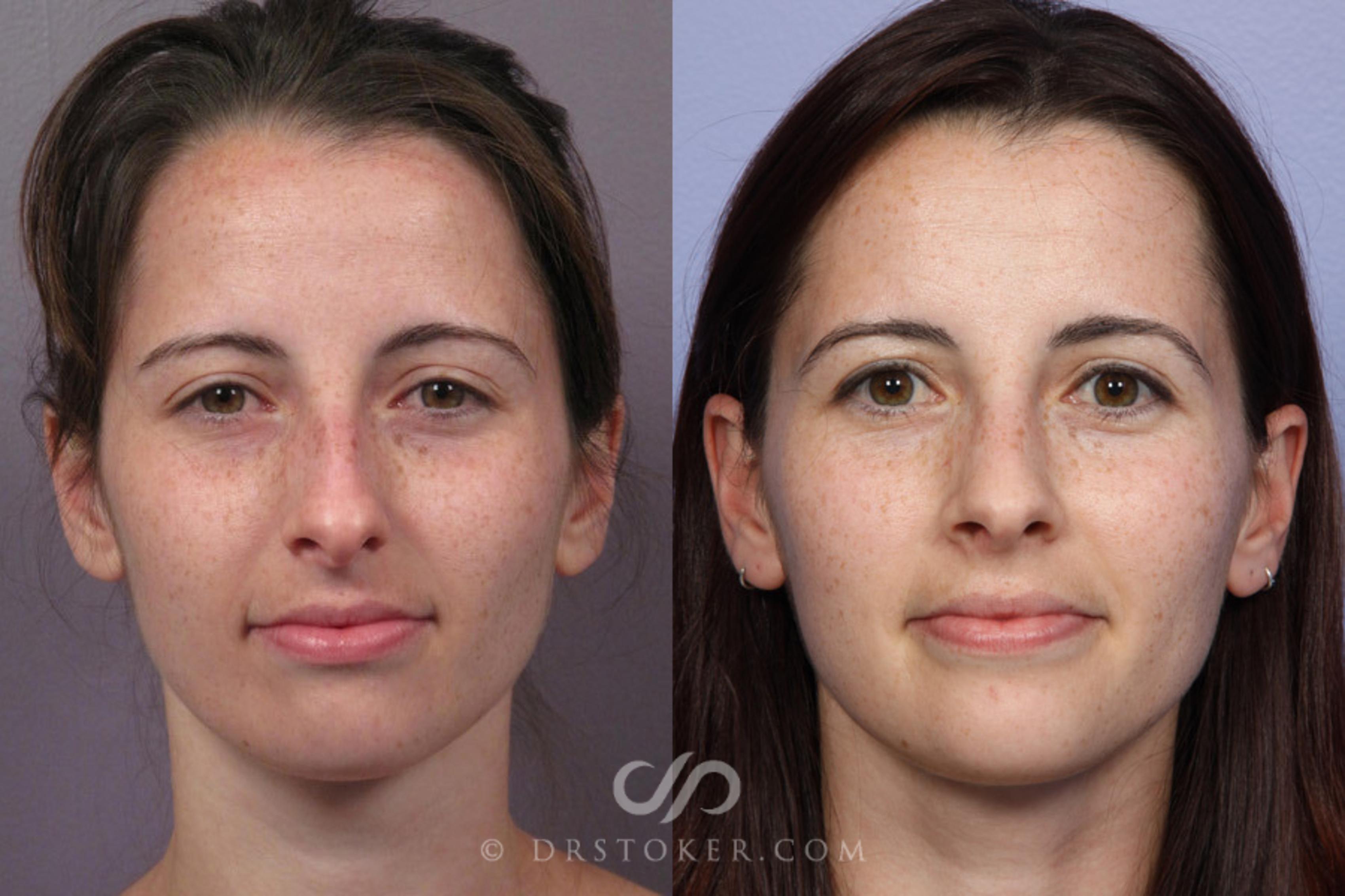 Before & After Rhinoplasty Case 276 View #1 View in Los Angeles, CA