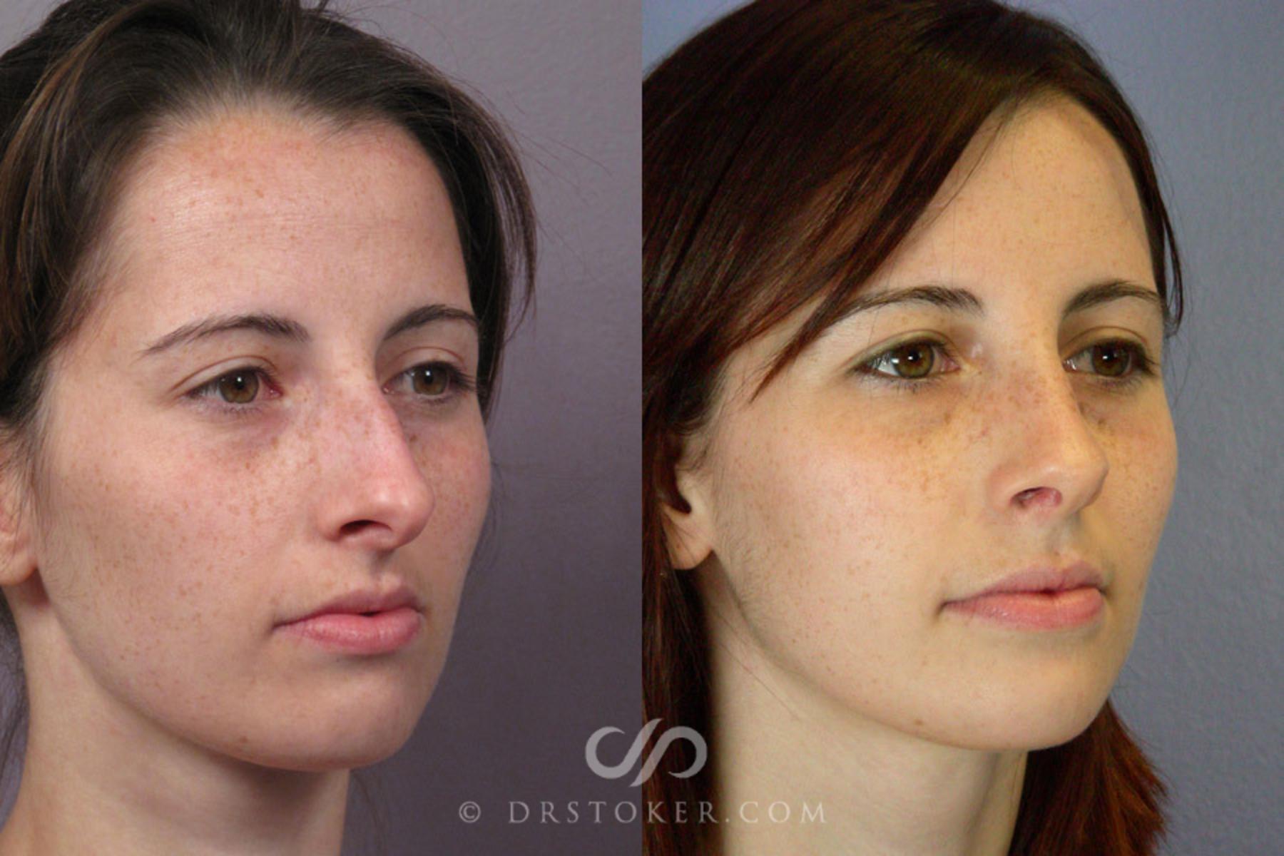 Before & After Rhinoplasty Case 276 View #2 View in Los Angeles, CA