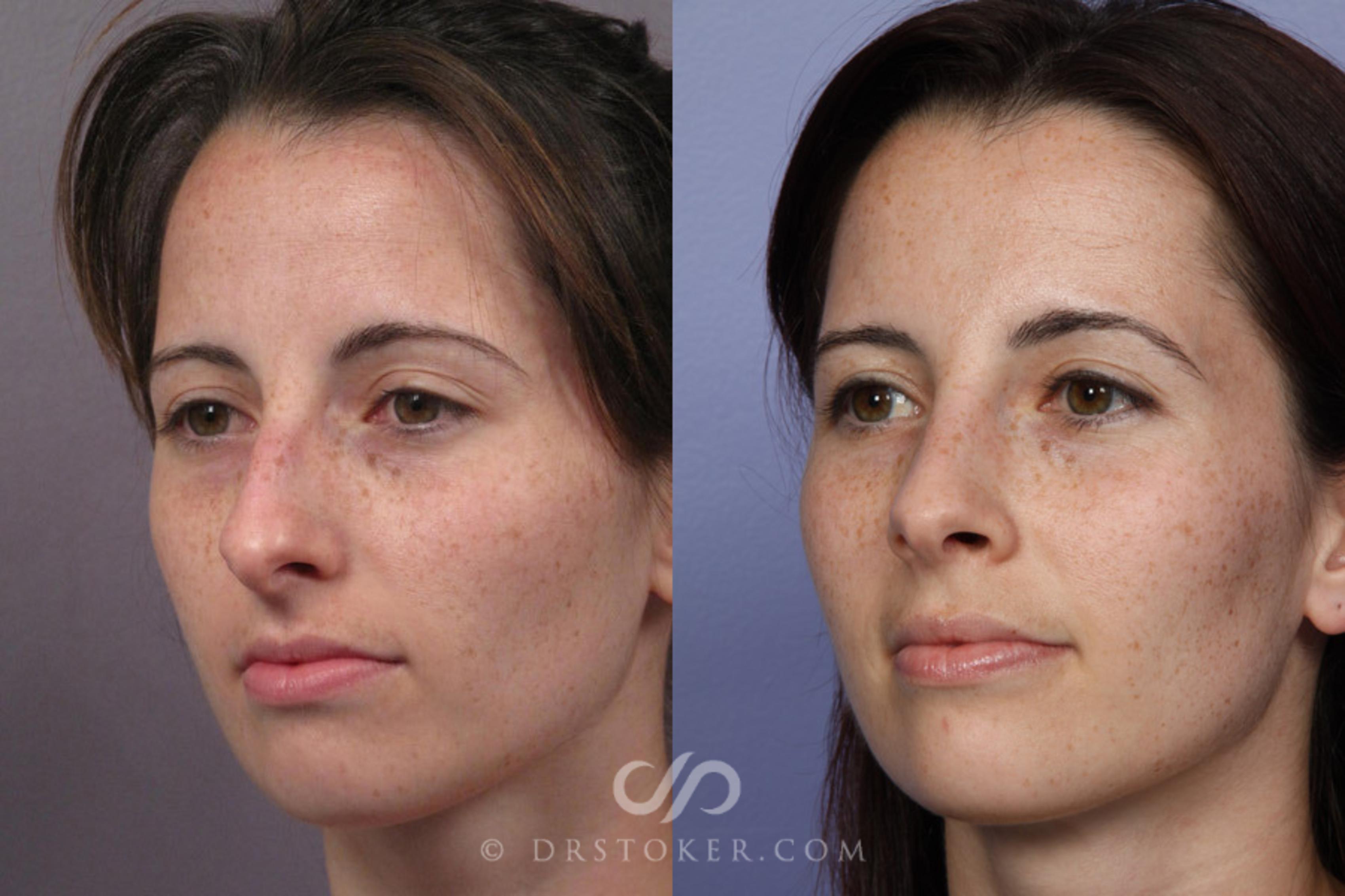 Before & After Rhinoplasty Case 276 View #3 View in Los Angeles, CA