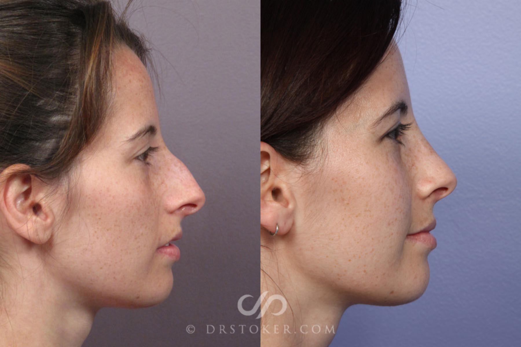 Before & After Rhinoplasty Case 276 View #4 View in Los Angeles, CA