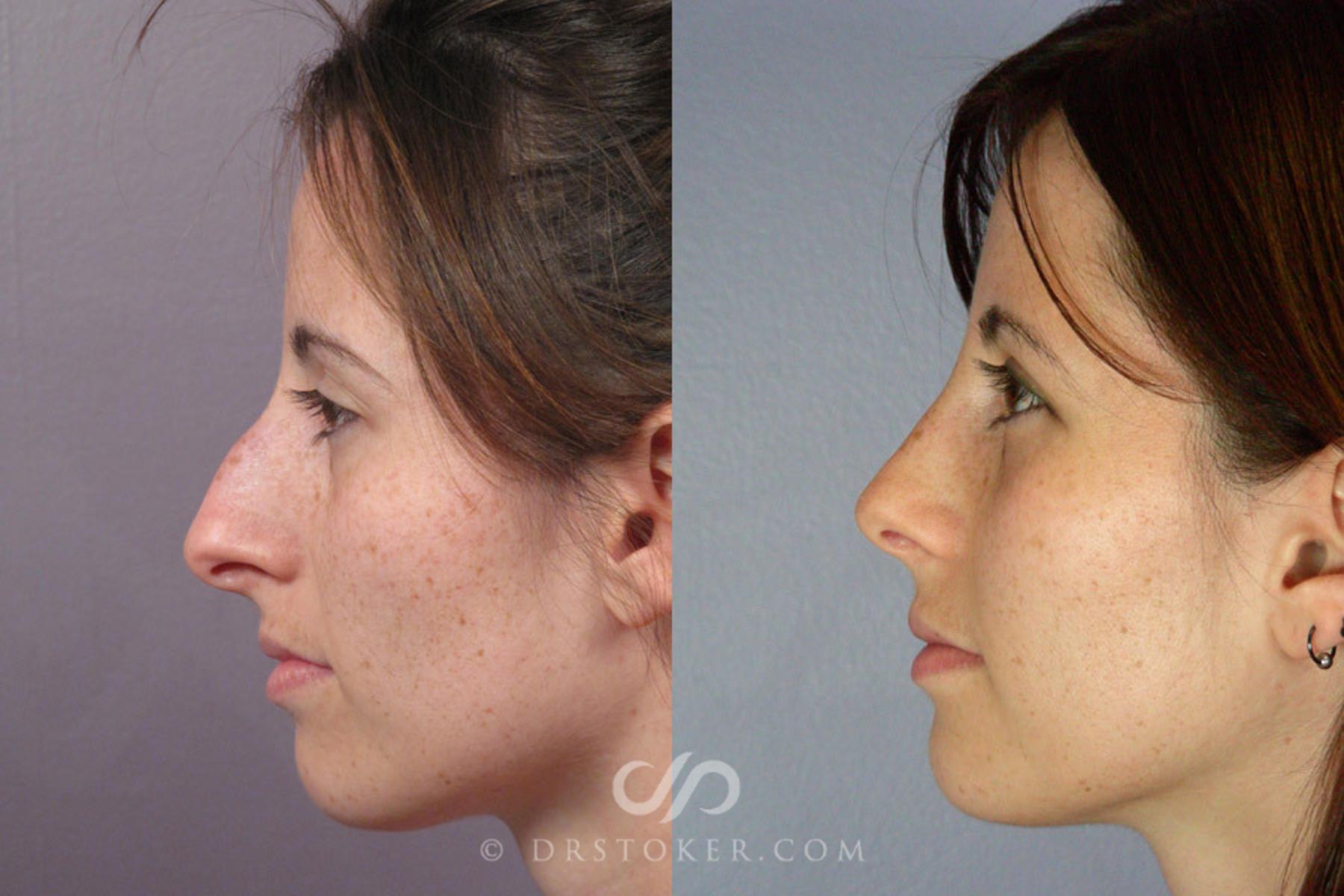 Before & After Rhinoplasty Case 276 View #5 View in Los Angeles, CA
