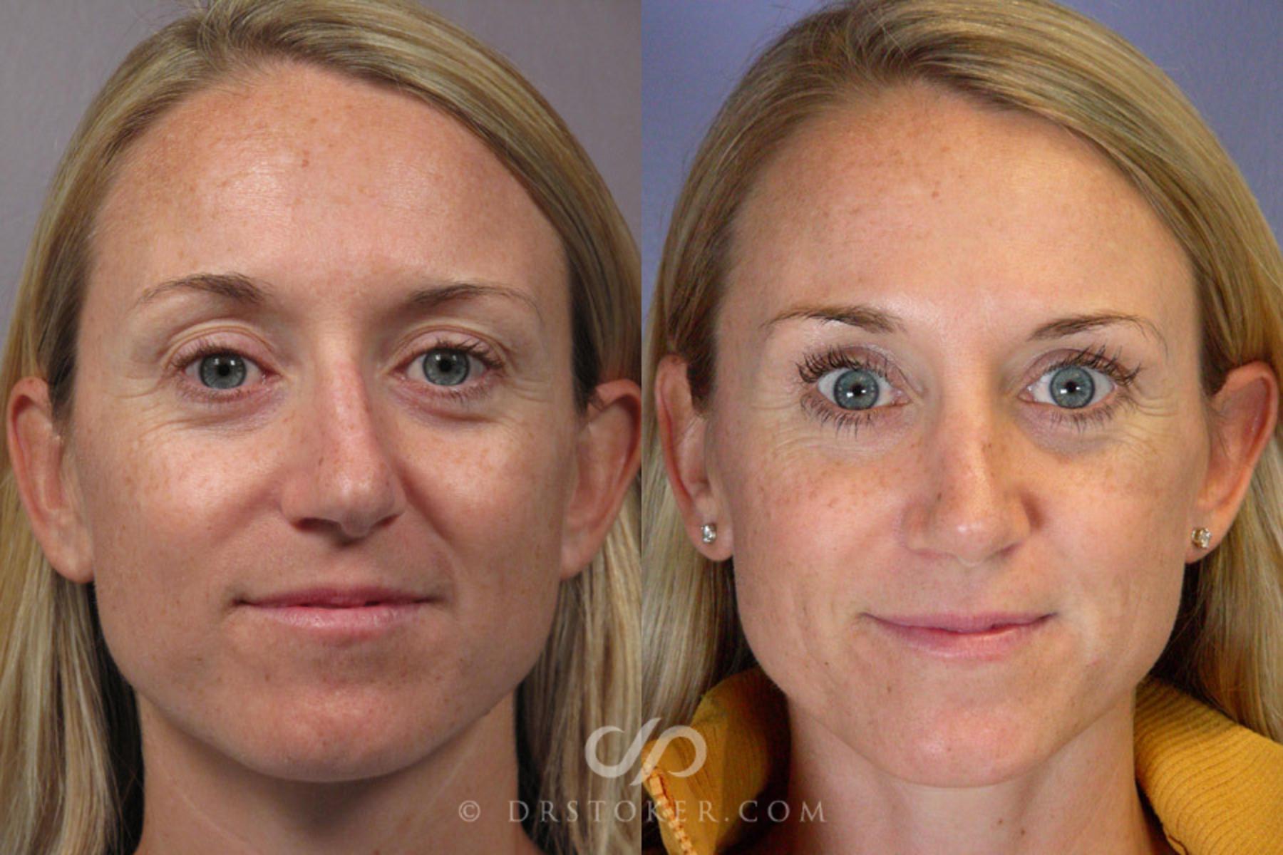 Before & After Rhinoplasty Case 277 View #1 View in Los Angeles, CA