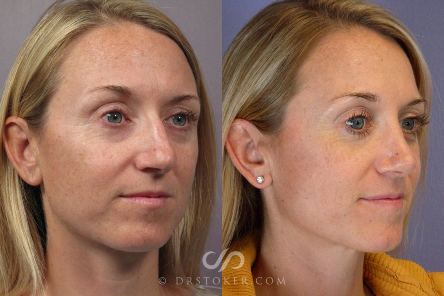 Before & After Rhinoplasty Case 277 View #2 View in Los Angeles, CA