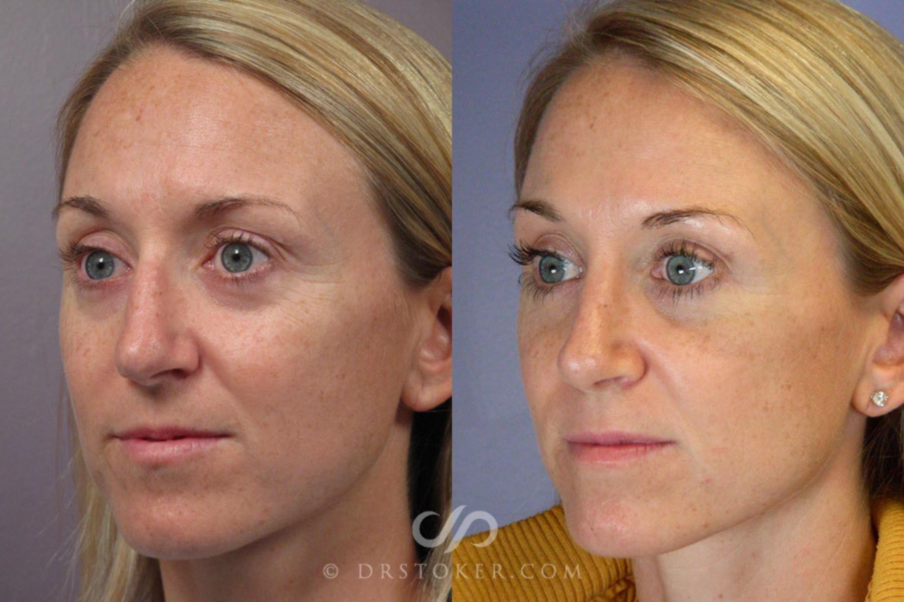 Before & After Rhinoplasty Case 277 View #3 View in Los Angeles, CA