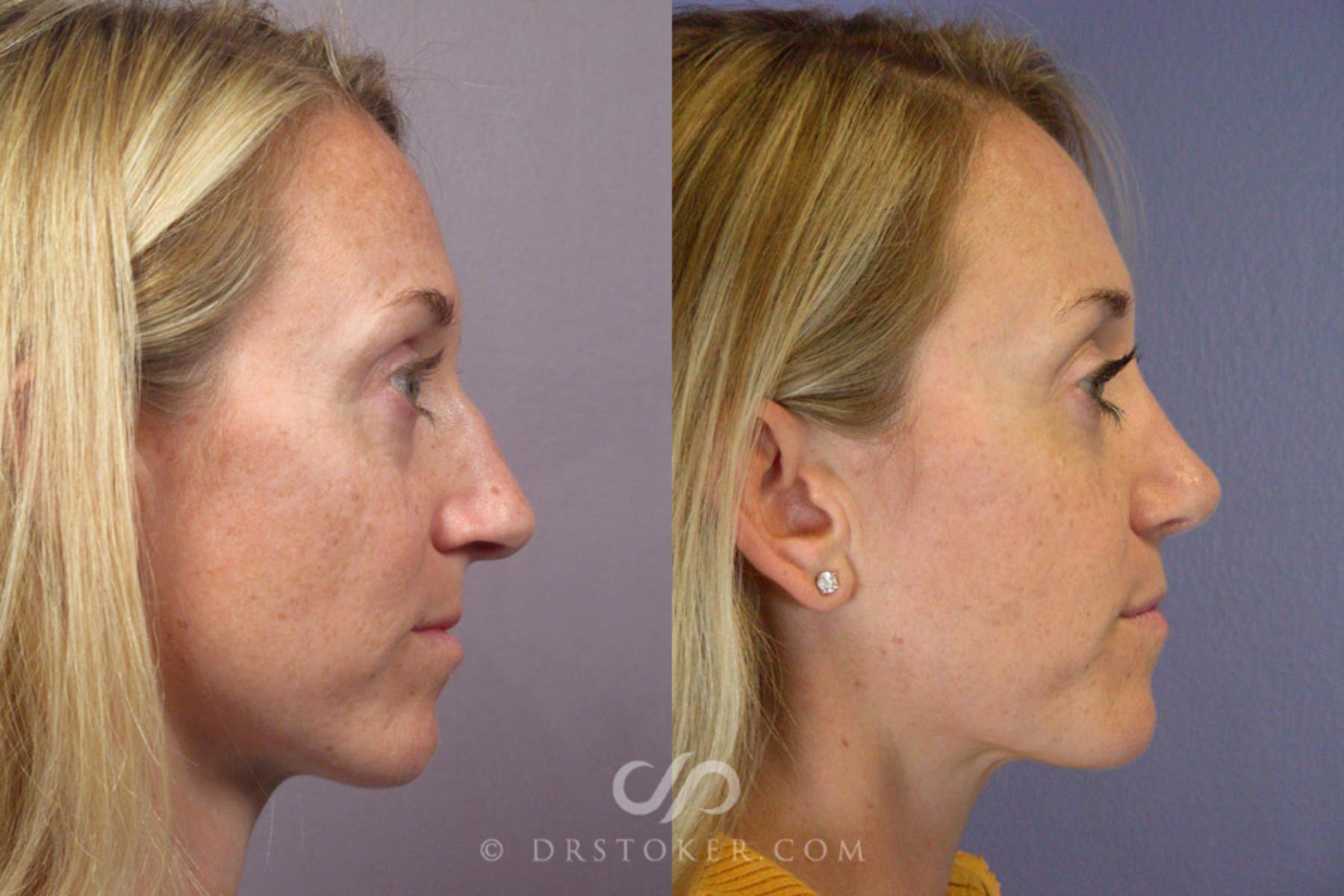 Before & After Rhinoplasty Case 277 View #4 View in Los Angeles, CA