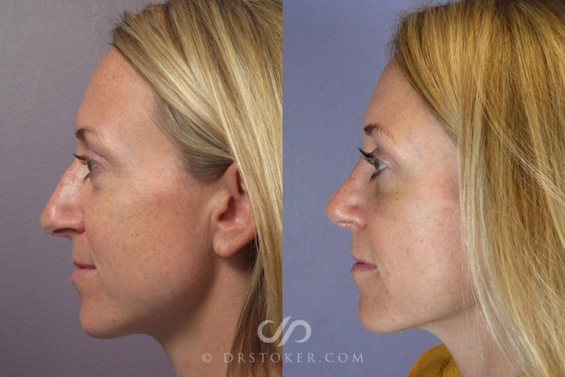 Before & After Rhinoplasty Case 277 View #5 View in Los Angeles, CA