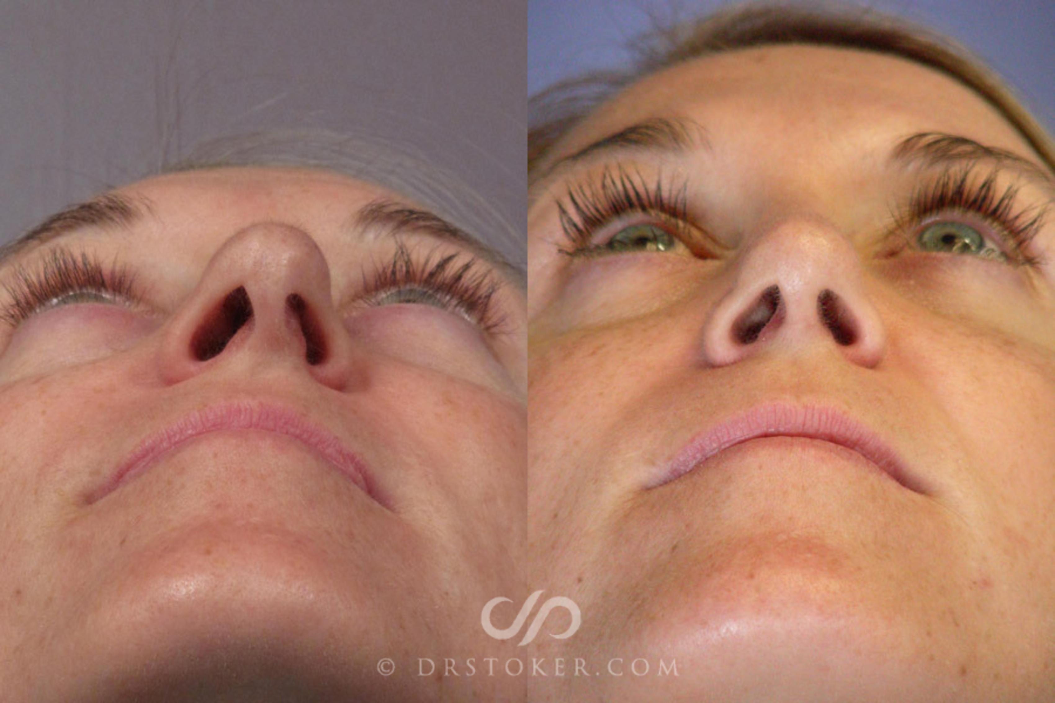 Before & After Rhinoplasty Case 277 View #6 View in Los Angeles, CA