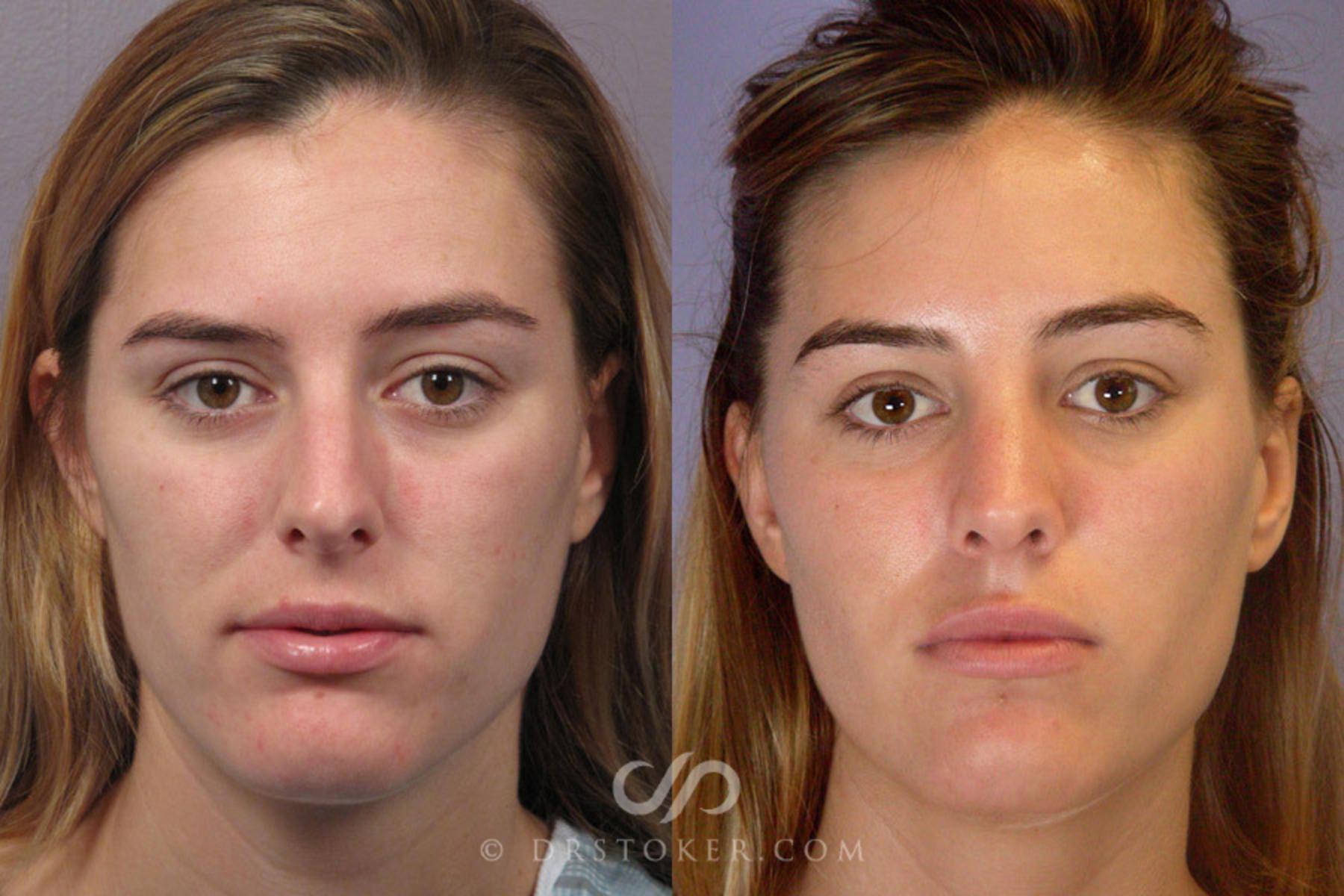 Before & After Rhinoplasty Case 278 View #1 View in Los Angeles, CA