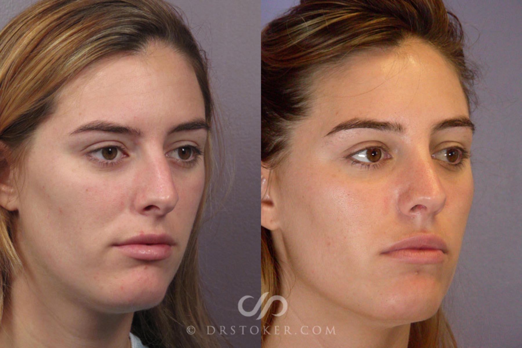 Before & After Rhinoplasty Case 278 View #2 View in Los Angeles, CA