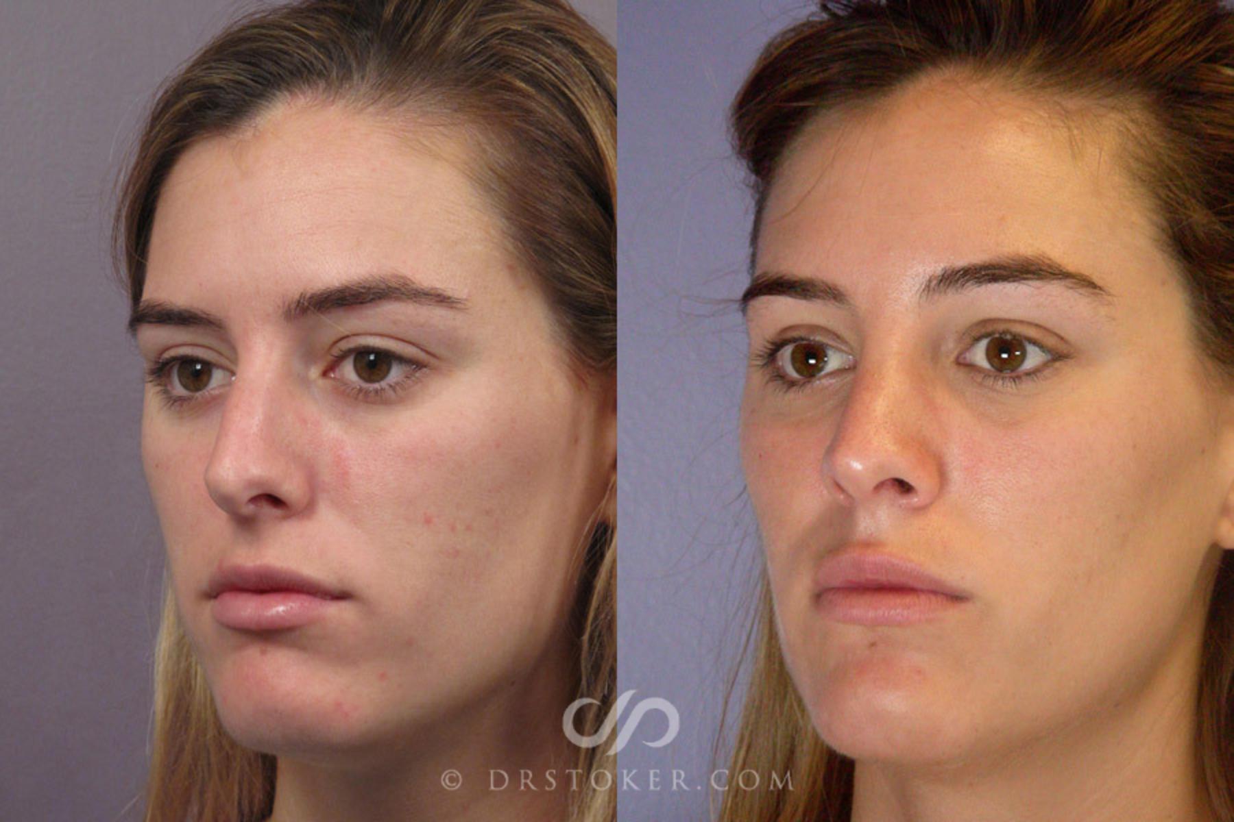 Before & After Rhinoplasty Case 278 View #3 View in Los Angeles, CA