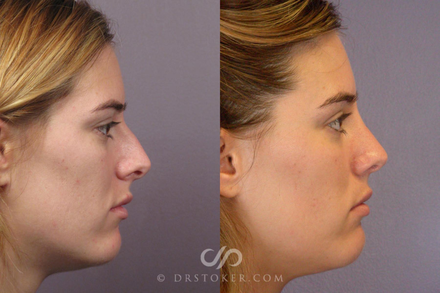 Before & After Rhinoplasty Case 278 View #4 View in Los Angeles, CA