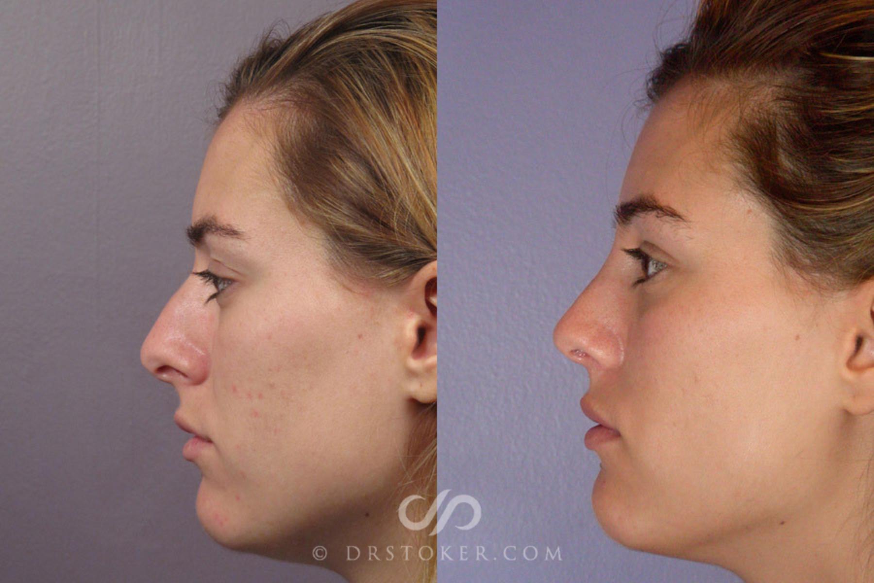 Before & After Rhinoplasty Case 278 View #5 View in Los Angeles, CA