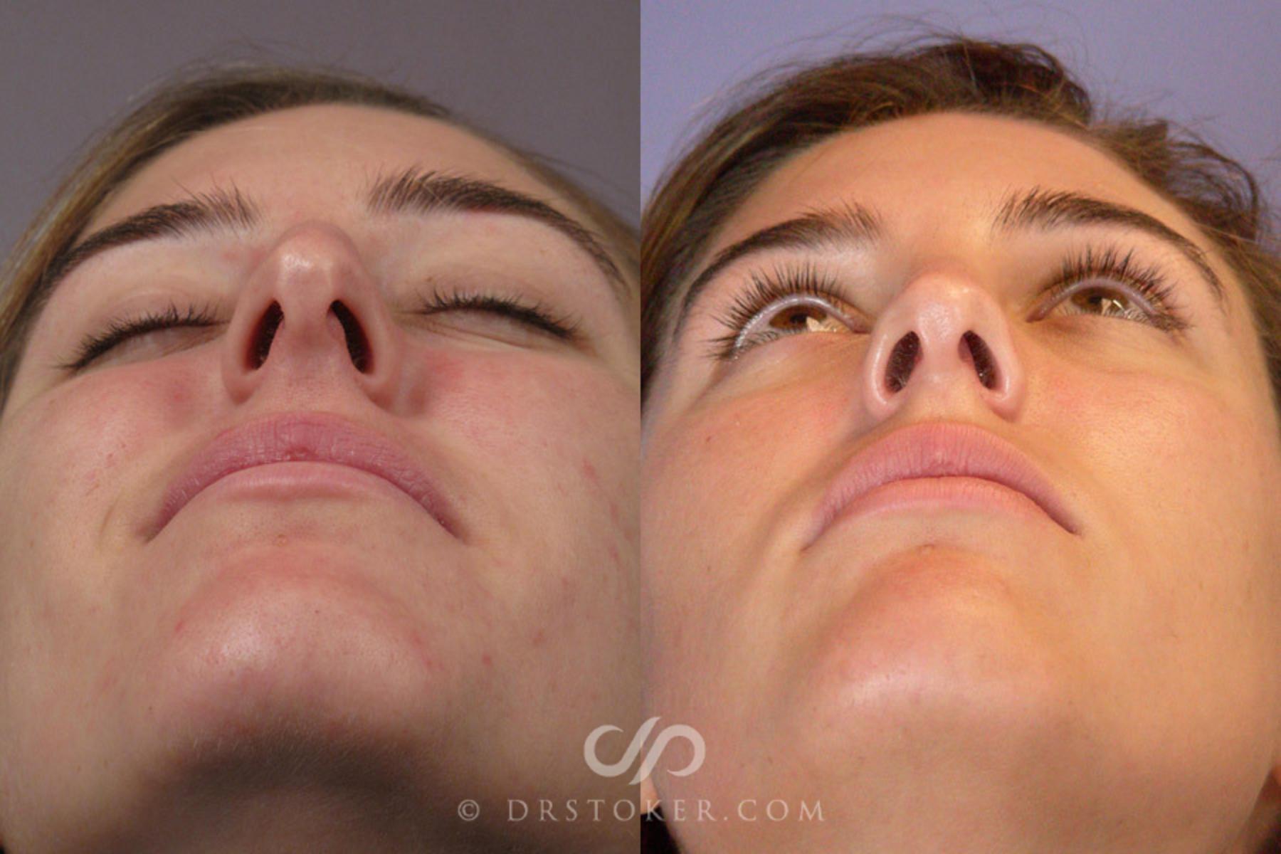 Before & After Rhinoplasty Case 278 View #6 View in Los Angeles, CA