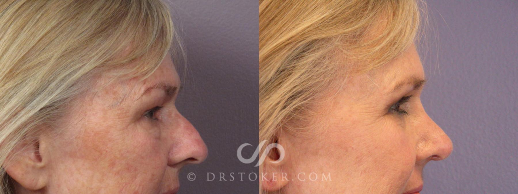Before & After Eyelid Surgery Case 279 View #10 View in Los Angeles, CA