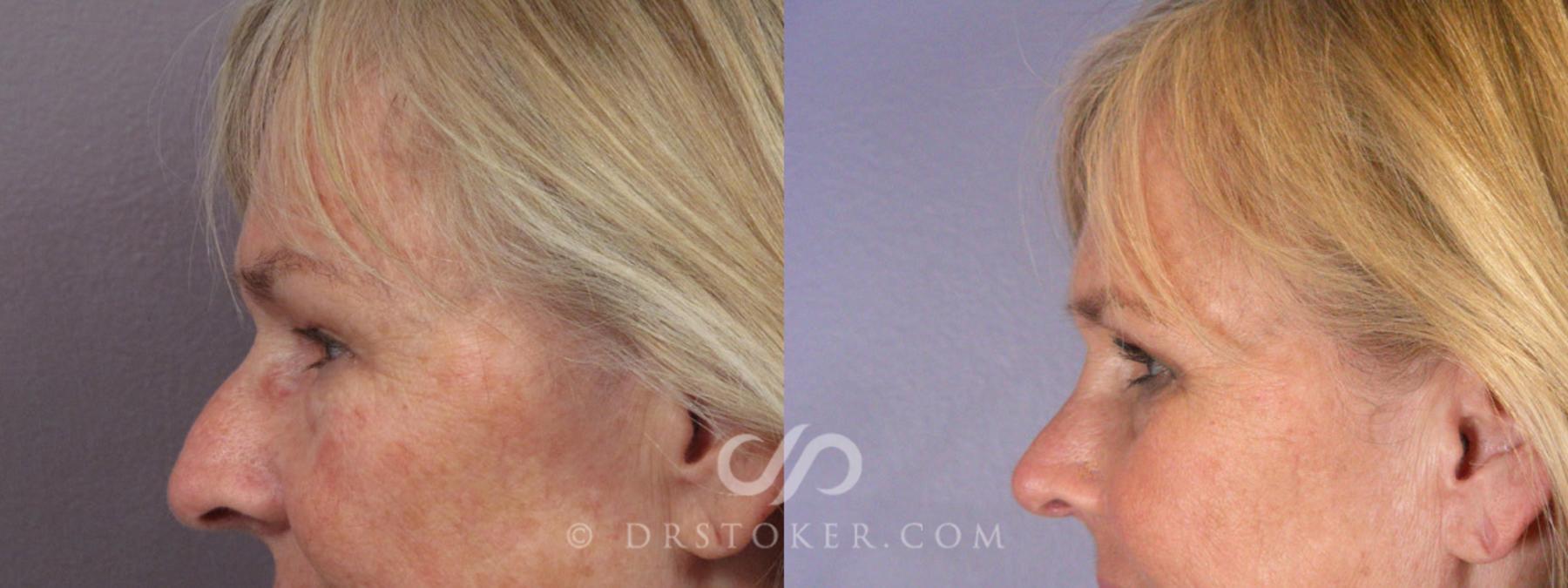Before & After Rhinoplasty Case 279 View #11 View in Los Angeles, CA