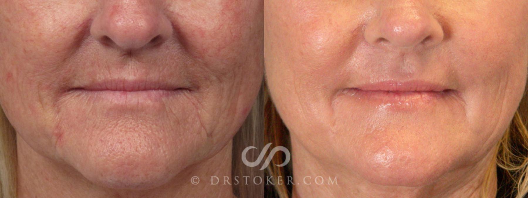 Before & After Laser Skin Resurfacing  Case 279 View #12 View in Los Angeles, CA