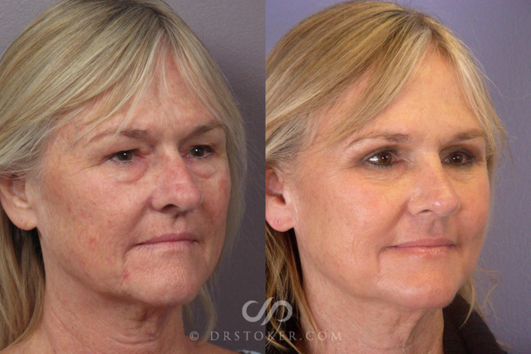 Before & After Eyelid Surgery Case 279 View #2 View in Los Angeles, CA