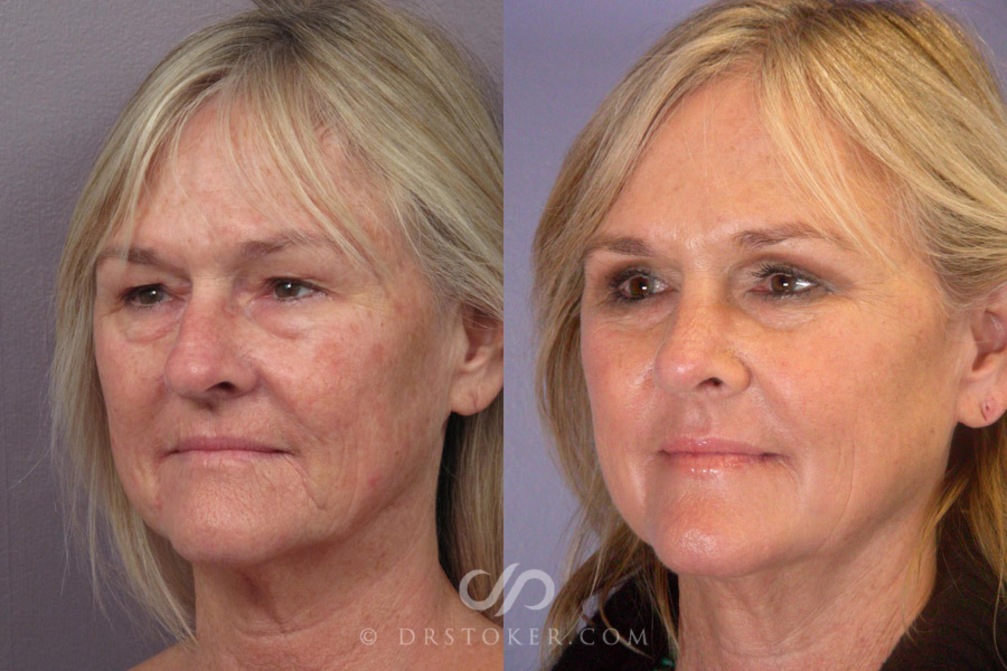 Before & After Rhinoplasty Case 279 View #3 View in Los Angeles, CA