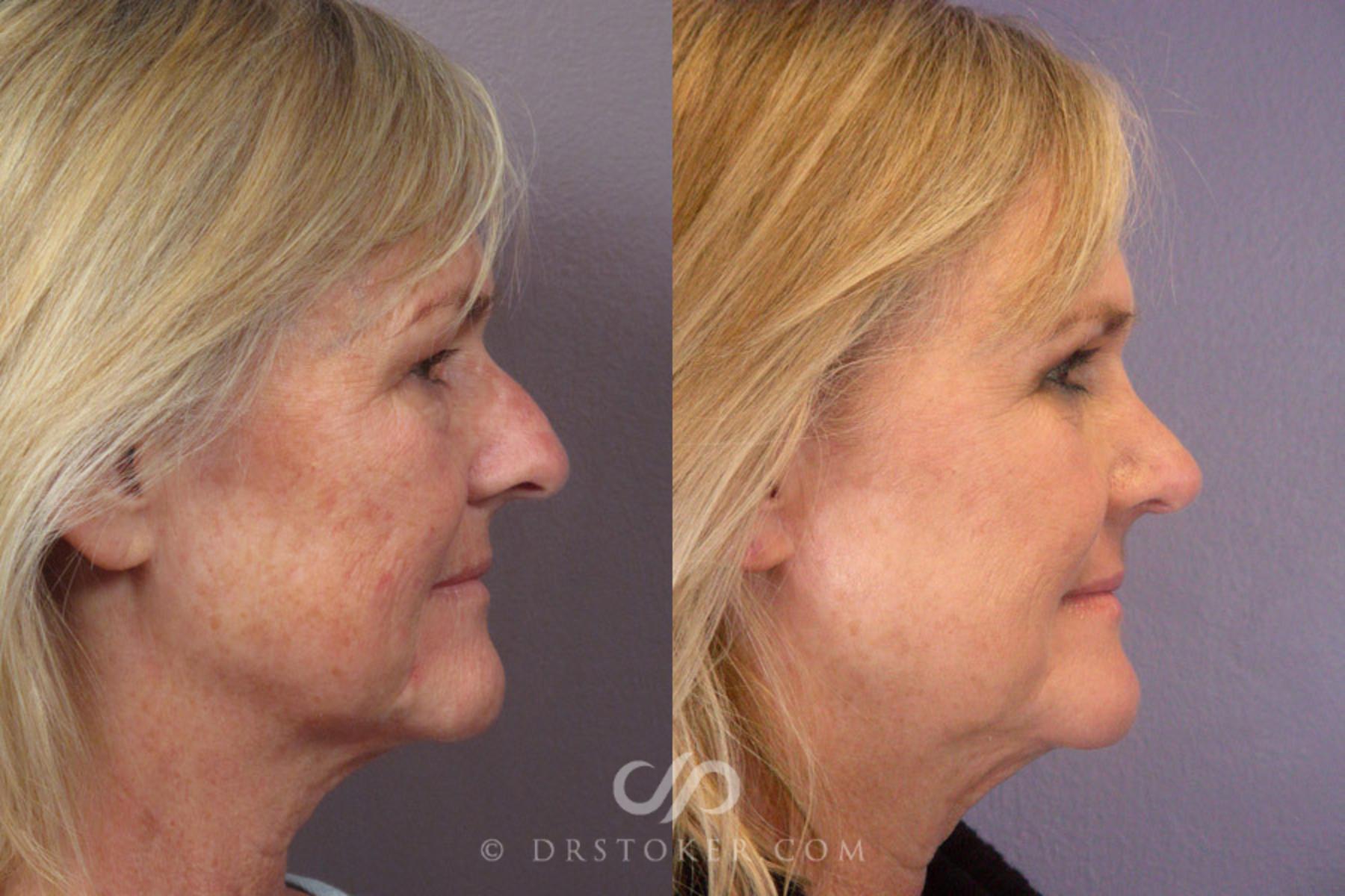 Before & After Eyelid Surgery Case 279 View #4 View in Los Angeles, CA