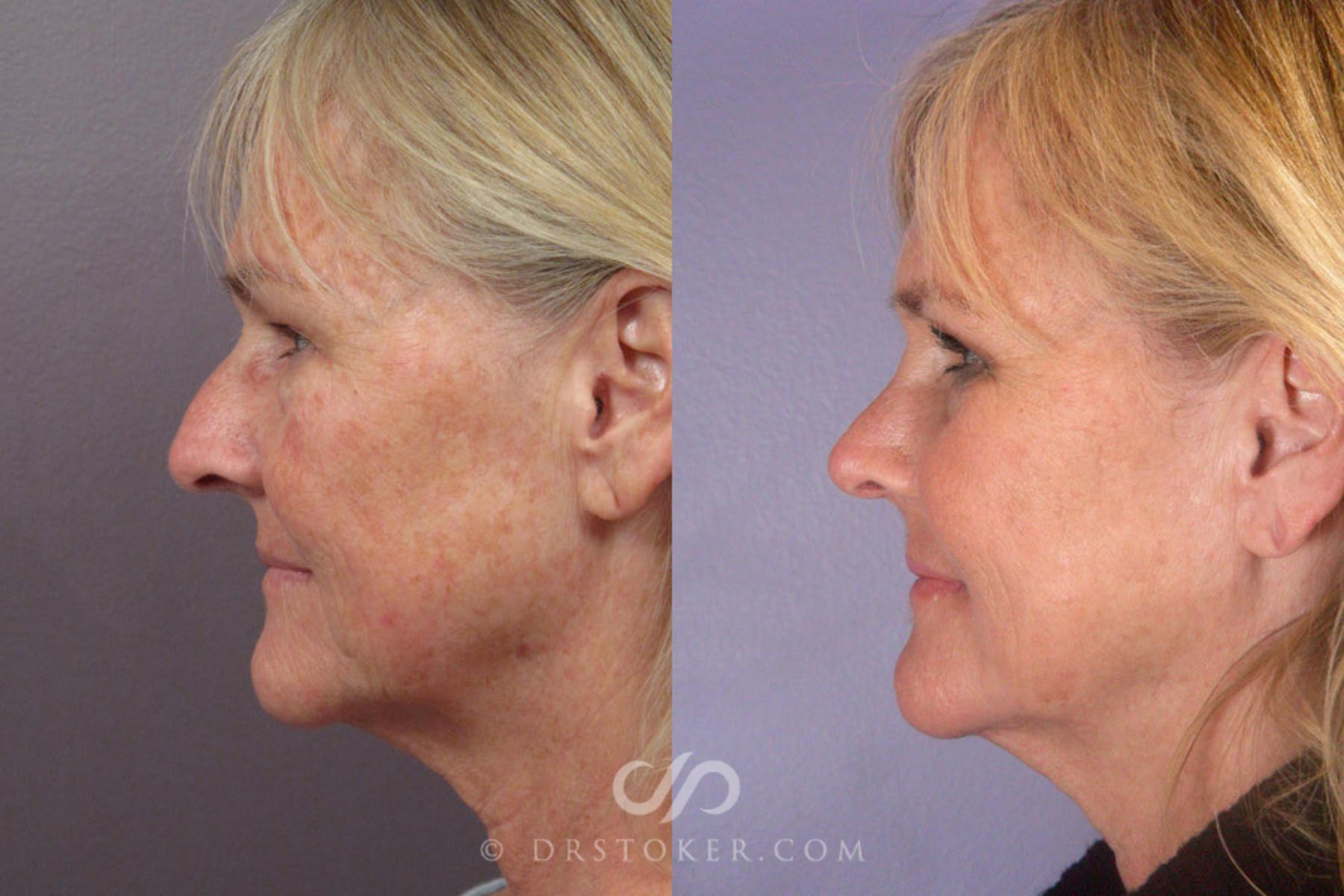 Before & After Laser Skin Resurfacing  Case 279 View #5 View in Los Angeles, CA