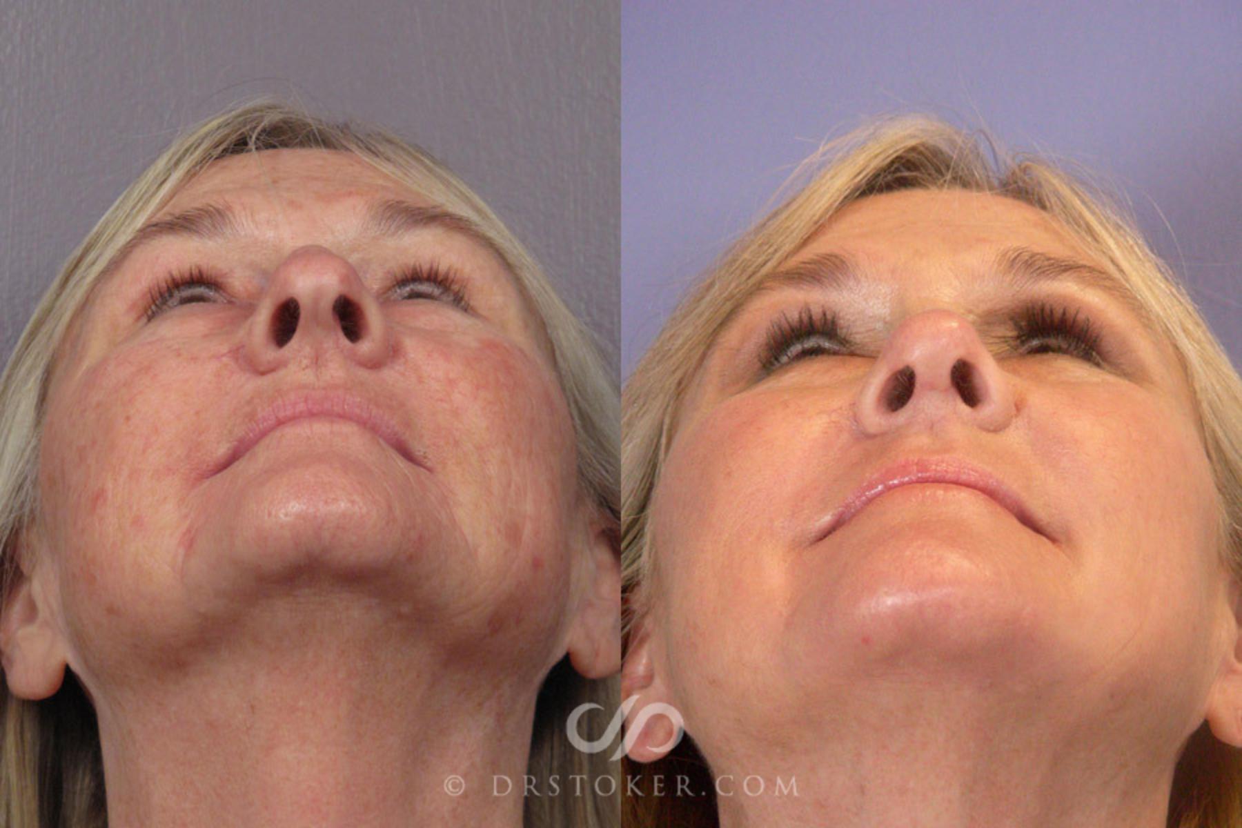 Before & After Laser Skin Resurfacing Case 279 View #6 View in Los Angeles, CA