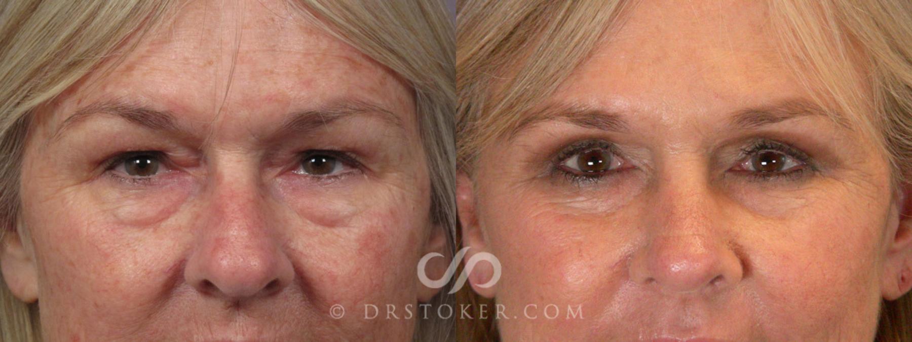 Before & After Laser Skin Resurfacing  Case 279 View #7 View in Los Angeles, CA