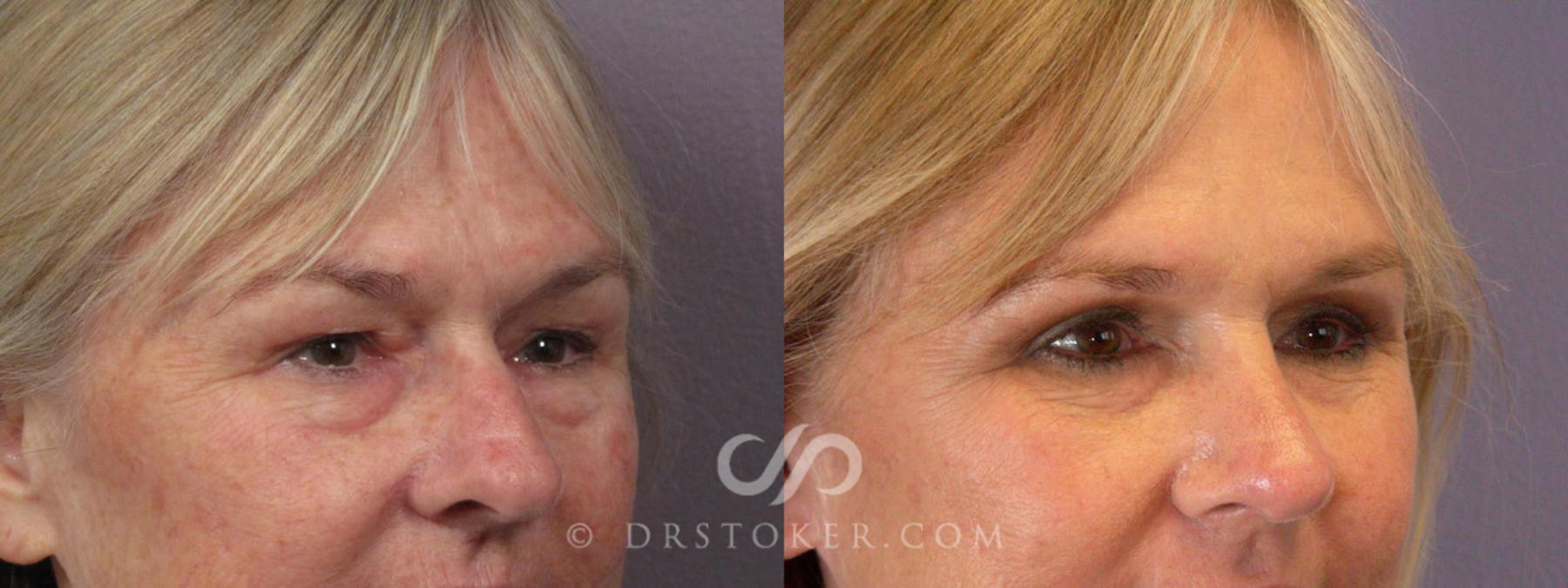 Before & After Laser Skin Resurfacing  Case 279 View #8 View in Los Angeles, CA