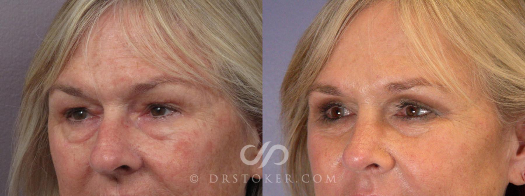 Before & After Eyelid Surgery Case 279 View #9 View in Los Angeles, CA