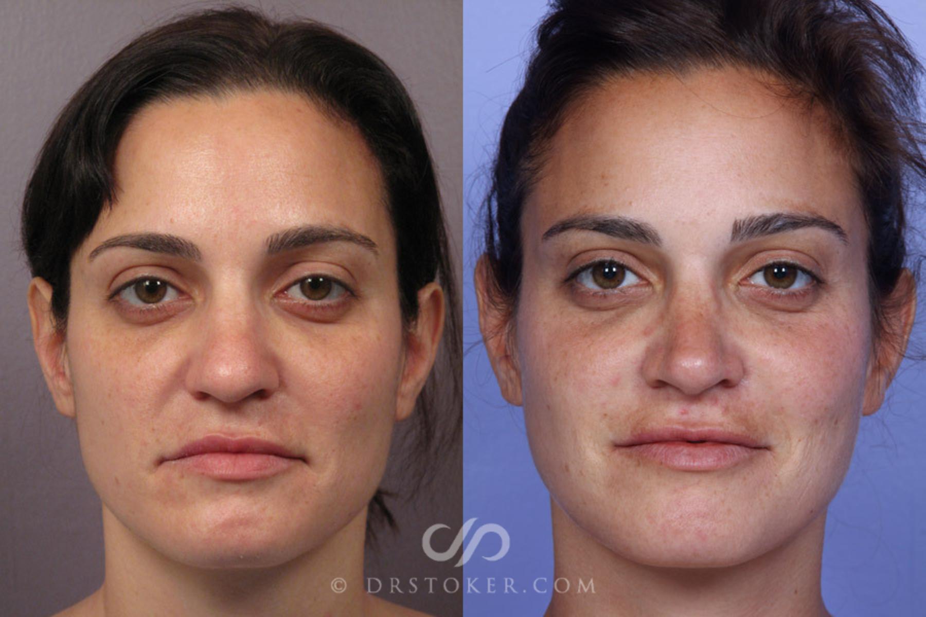 Before & After Rhinoplasty Case 280 View #1 View in Los Angeles, CA