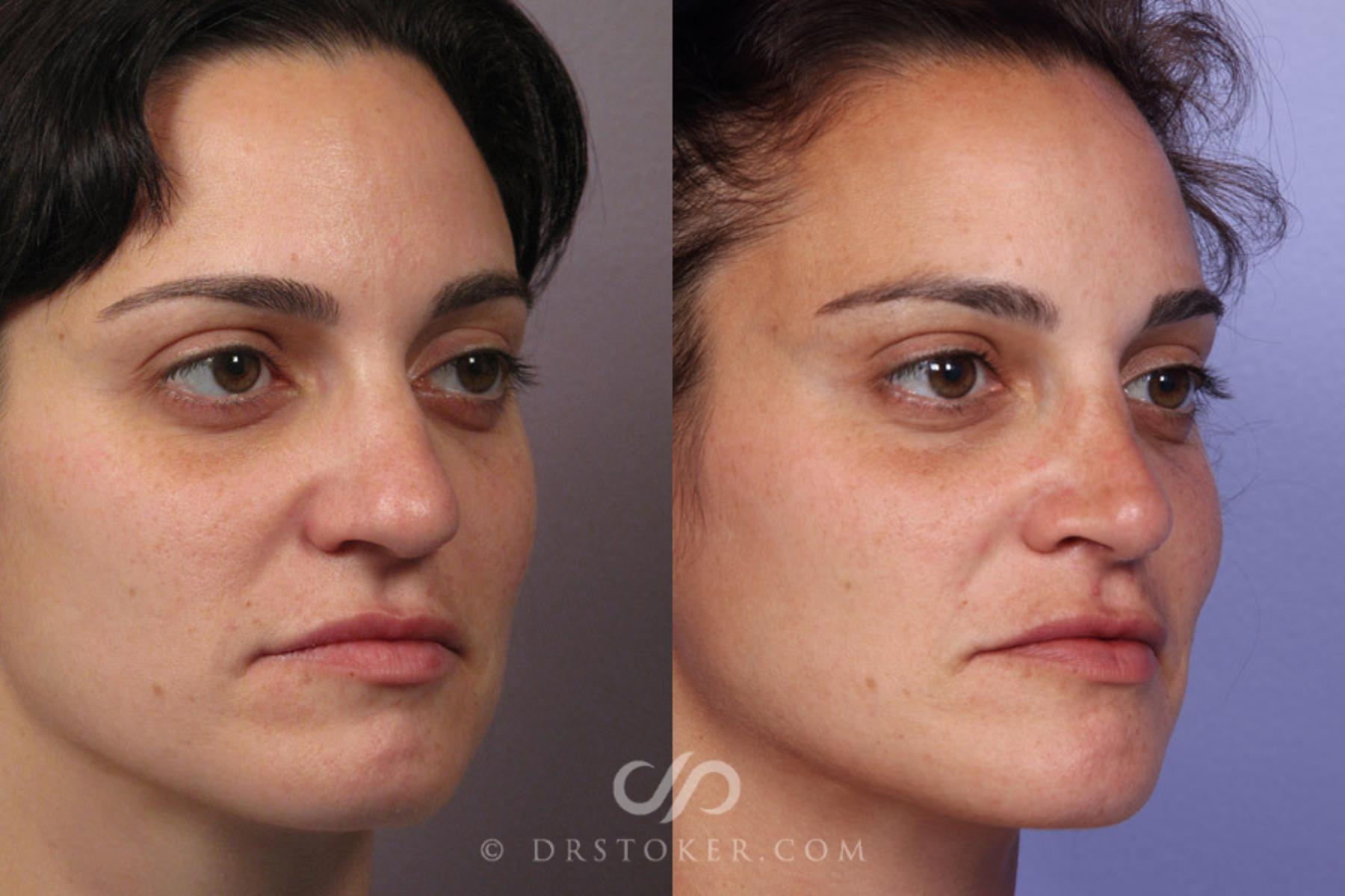 Before & After Rhinoplasty Case 280 View #4 View in Los Angeles, CA