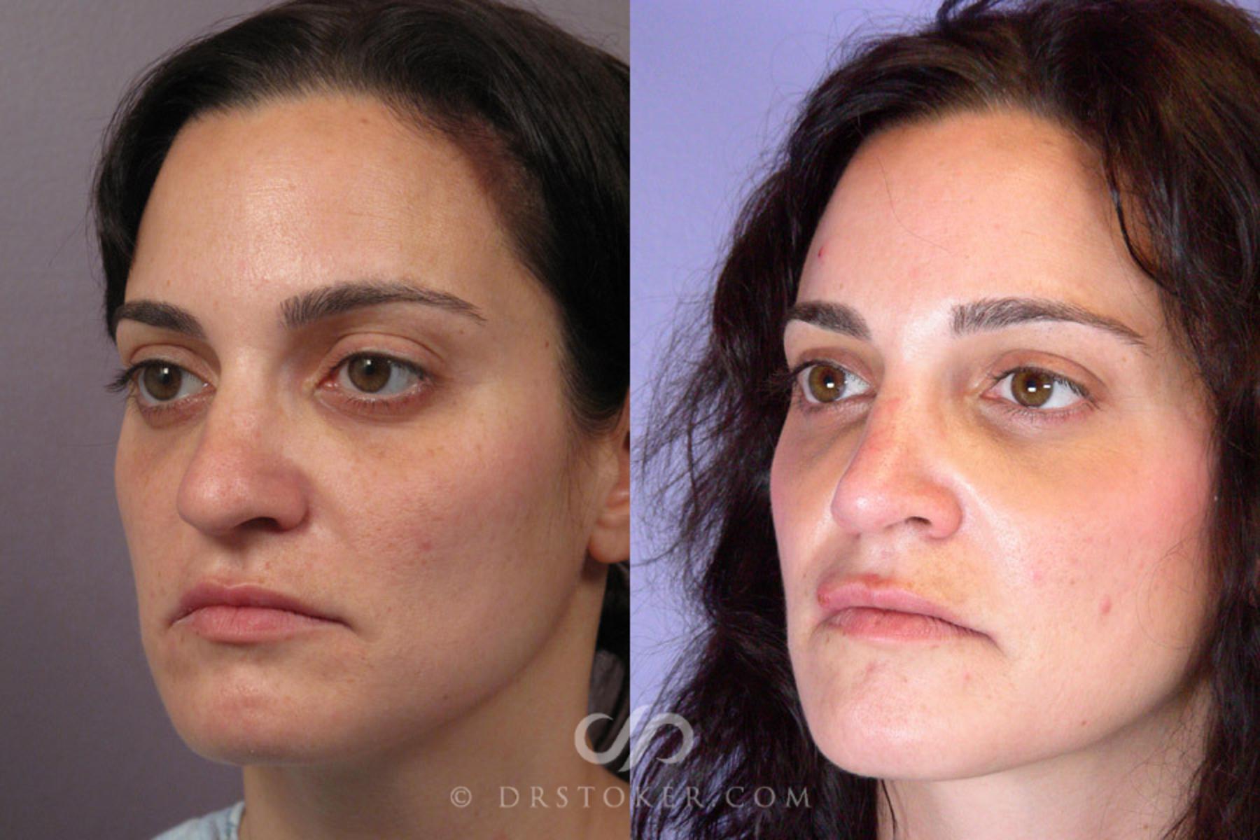 Before & After Rhinoplasty Case 280 View #5 View in Los Angeles, CA