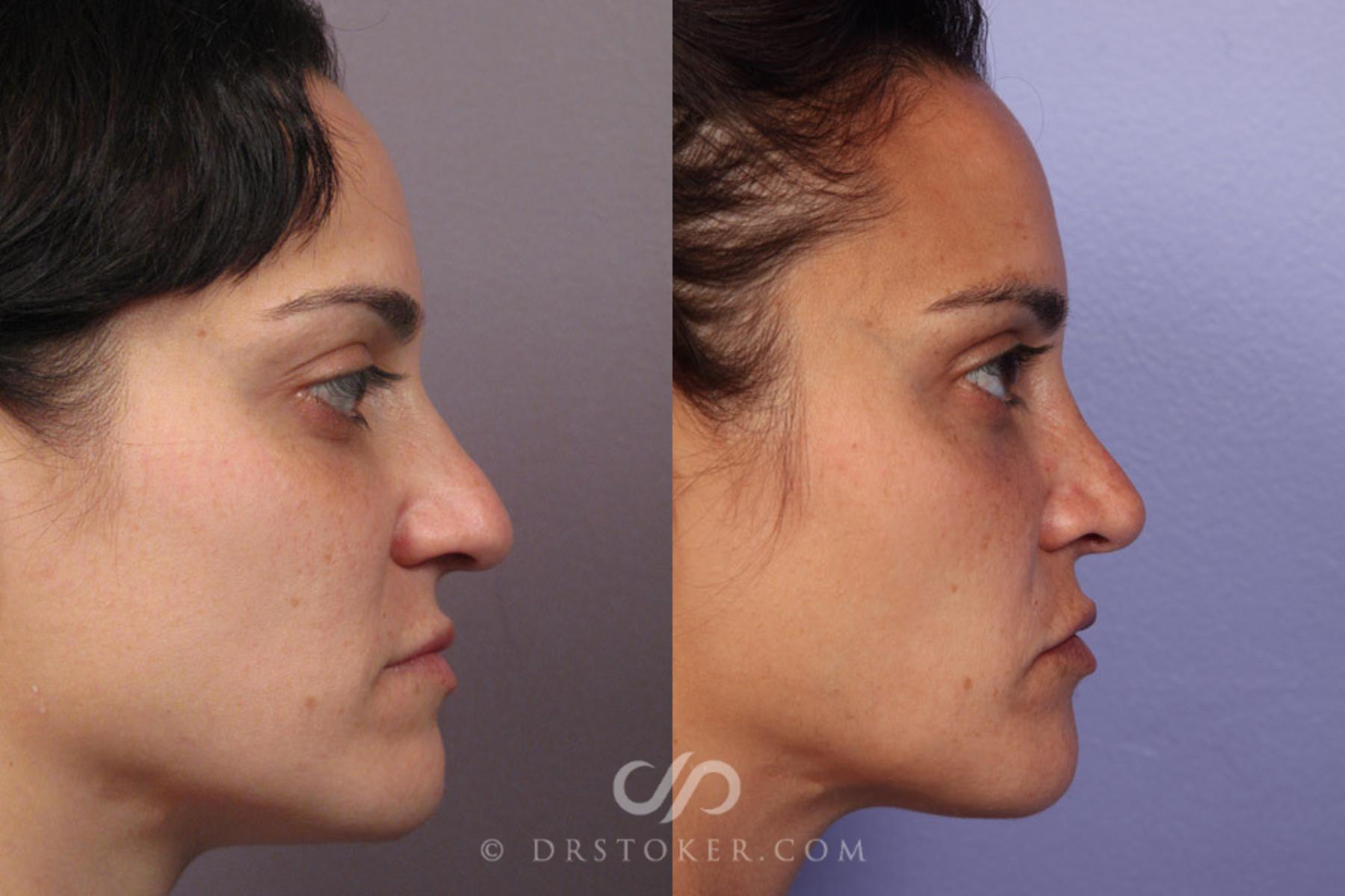 Before & After Rhinoplasty Case 280 View #7 View in Los Angeles, CA