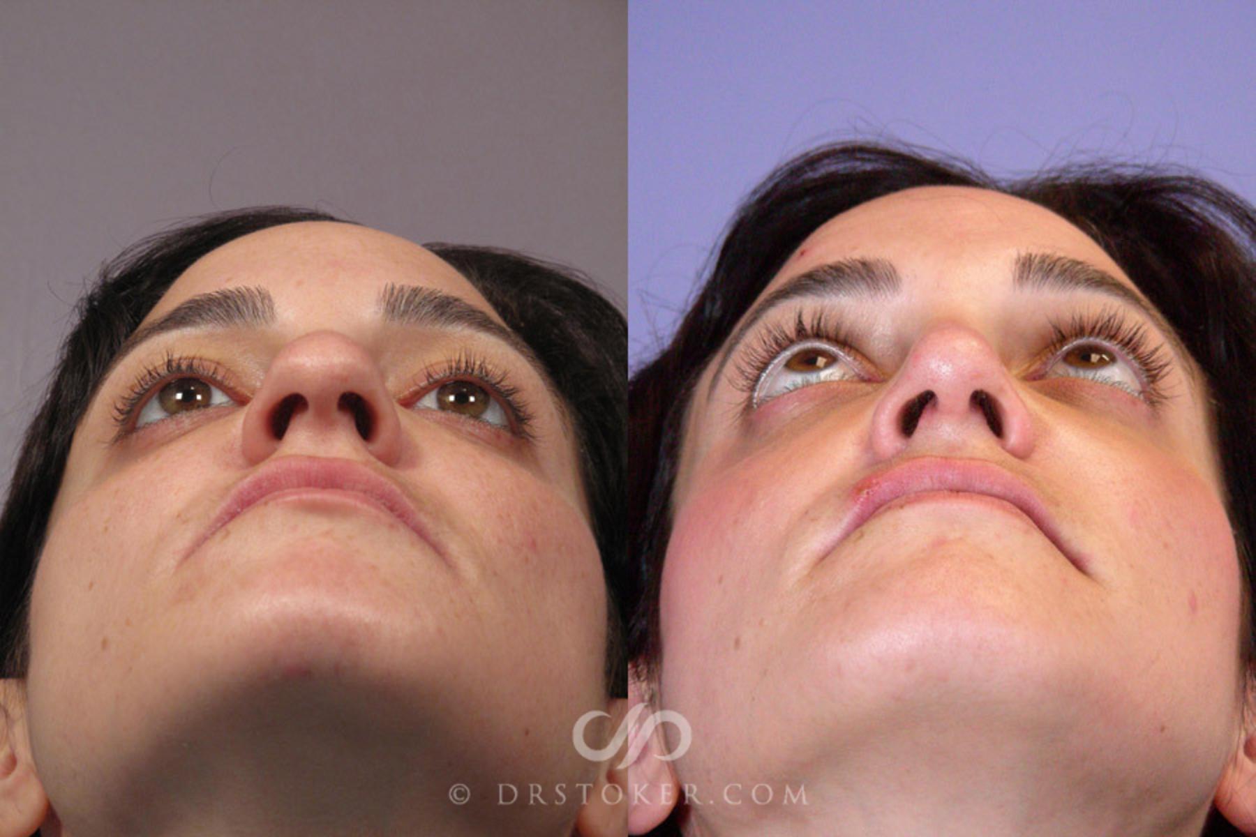 Before & After Rhinoplasty Case 280 View #8 View in Los Angeles, CA