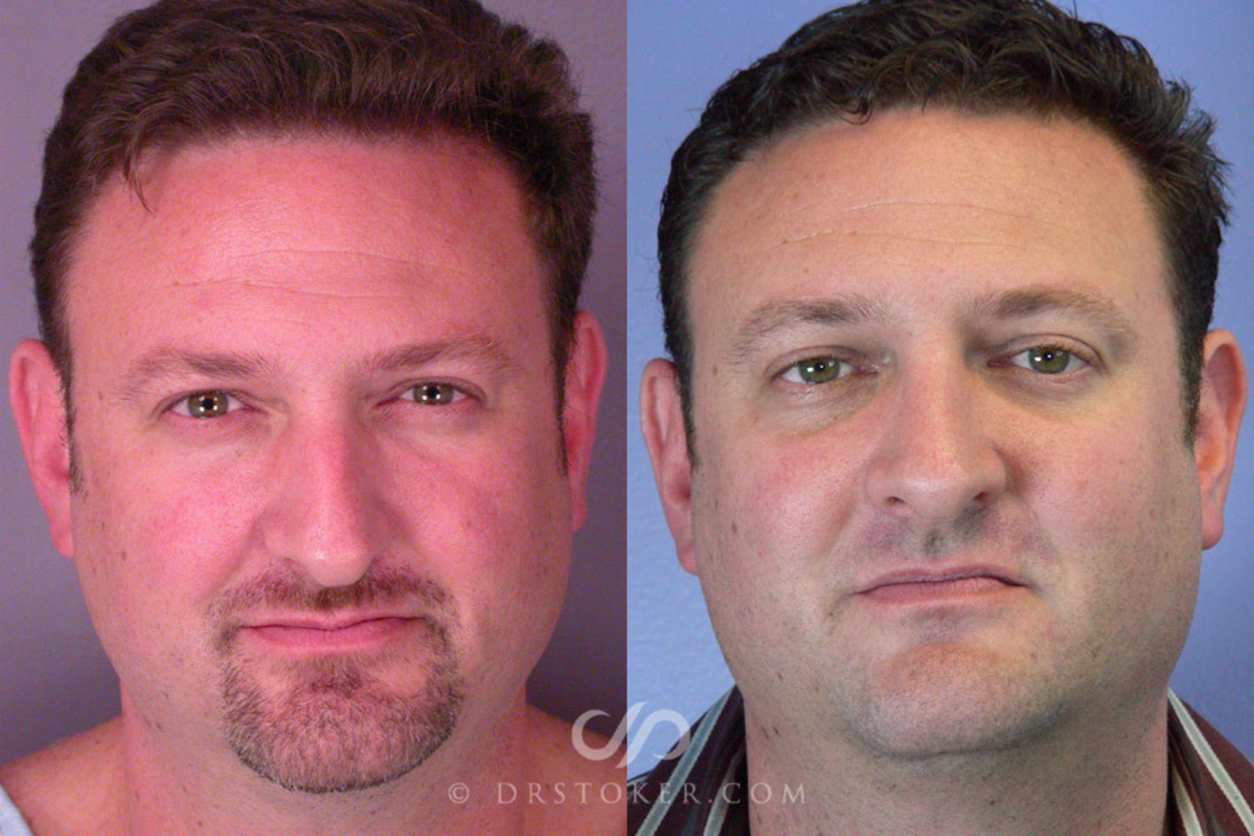 Before & After Rhinoplasty Case 291 View #1 View in Los Angeles, CA