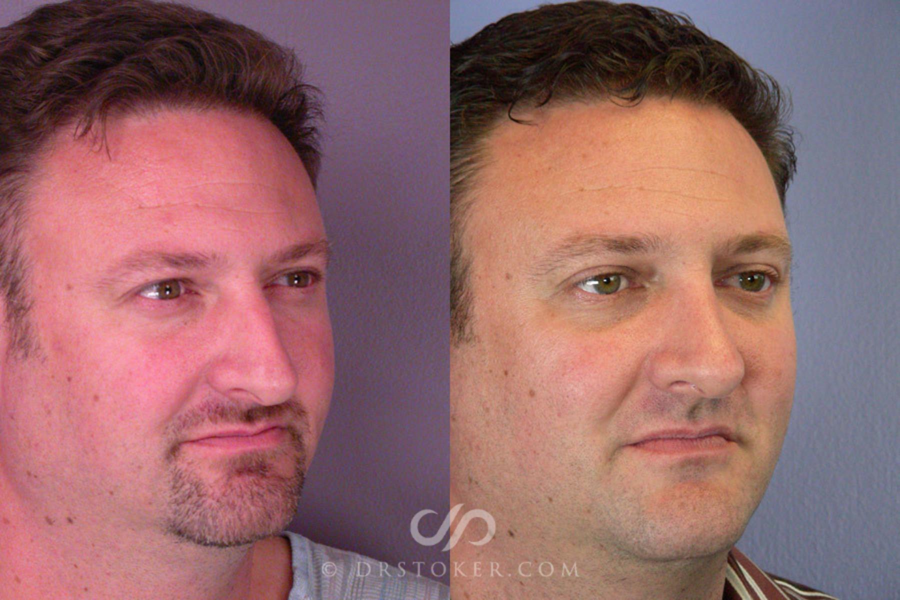 Before & After Rhinoplasty Case 291 View #2 View in Los Angeles, CA