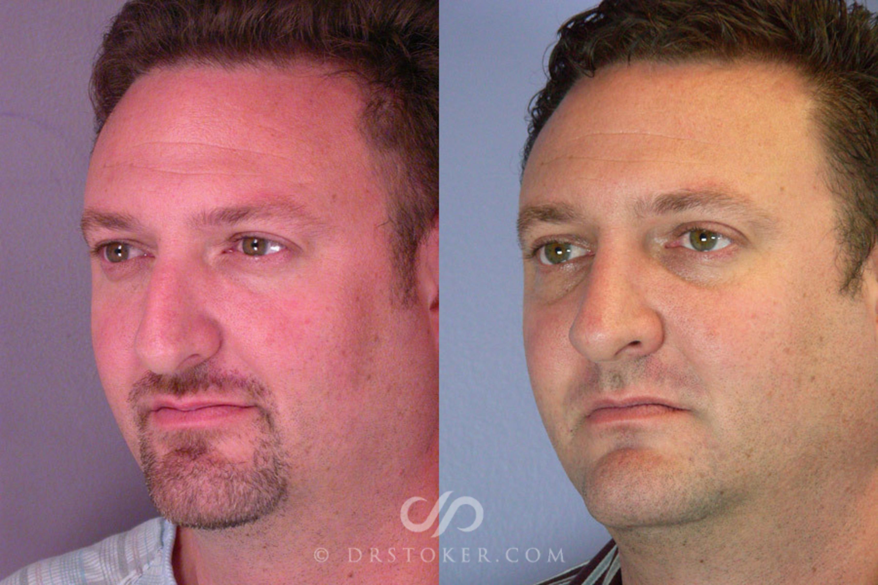 Before & After Rhinoplasty Case 291 View #4 View in Los Angeles, CA