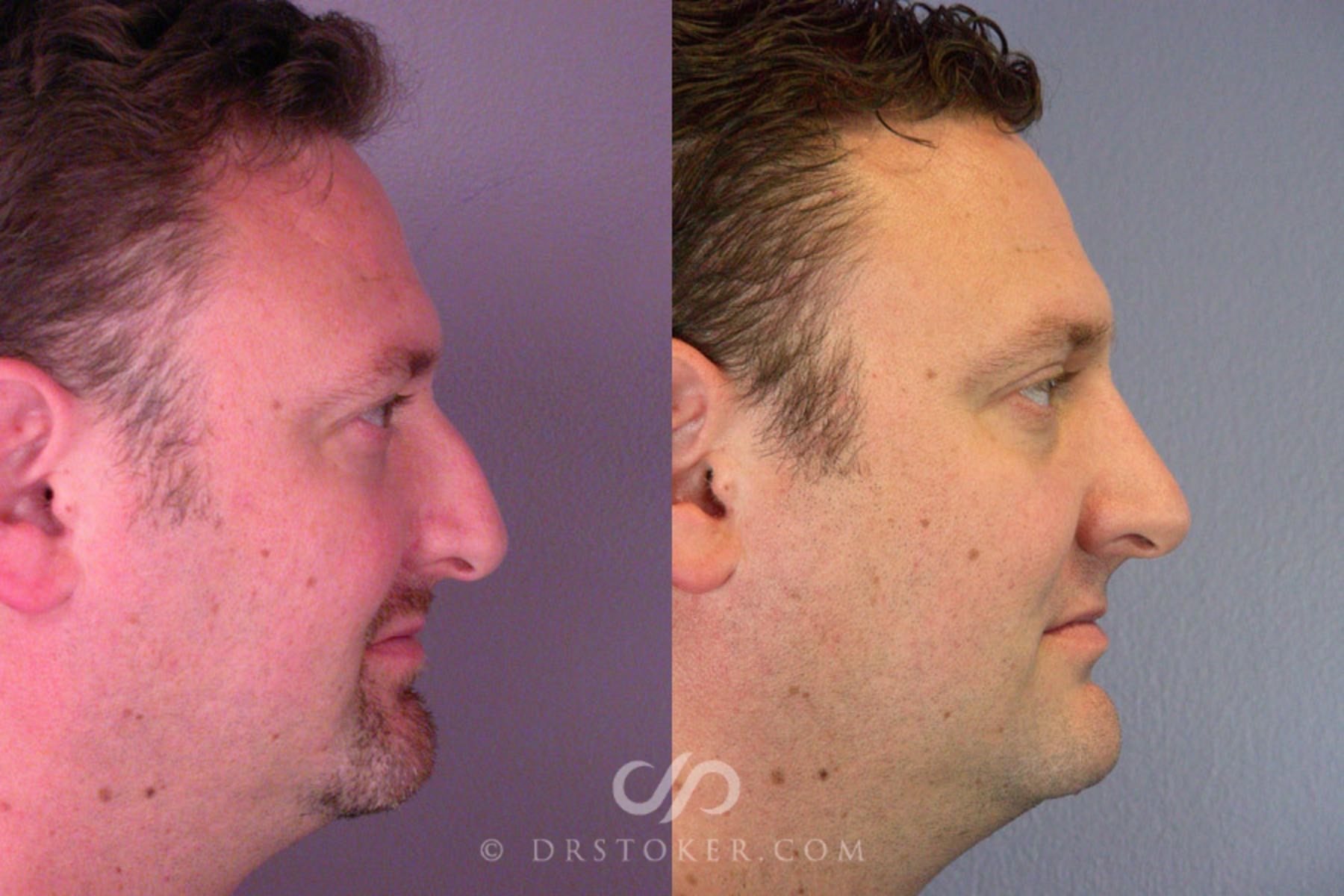 Before & After Rhinoplasty Case 291 View #5 View in Los Angeles, CA