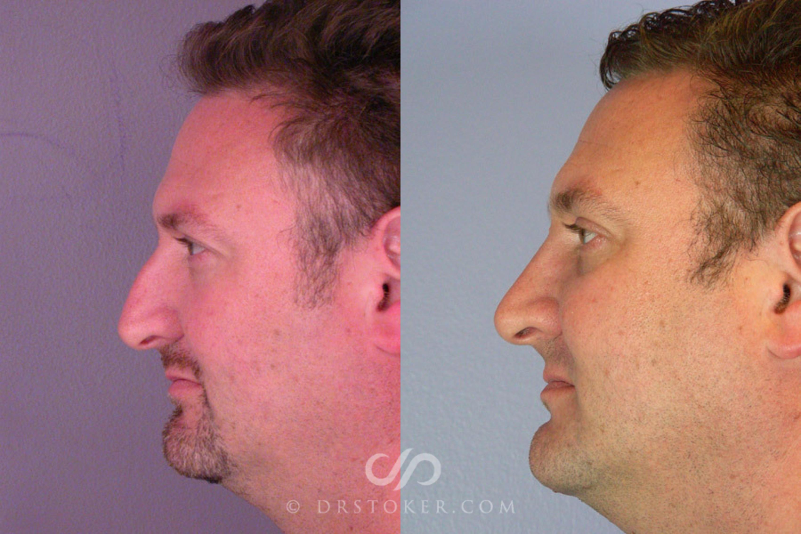 Before & After Rhinoplasty Case 291 View #6 View in Los Angeles, CA