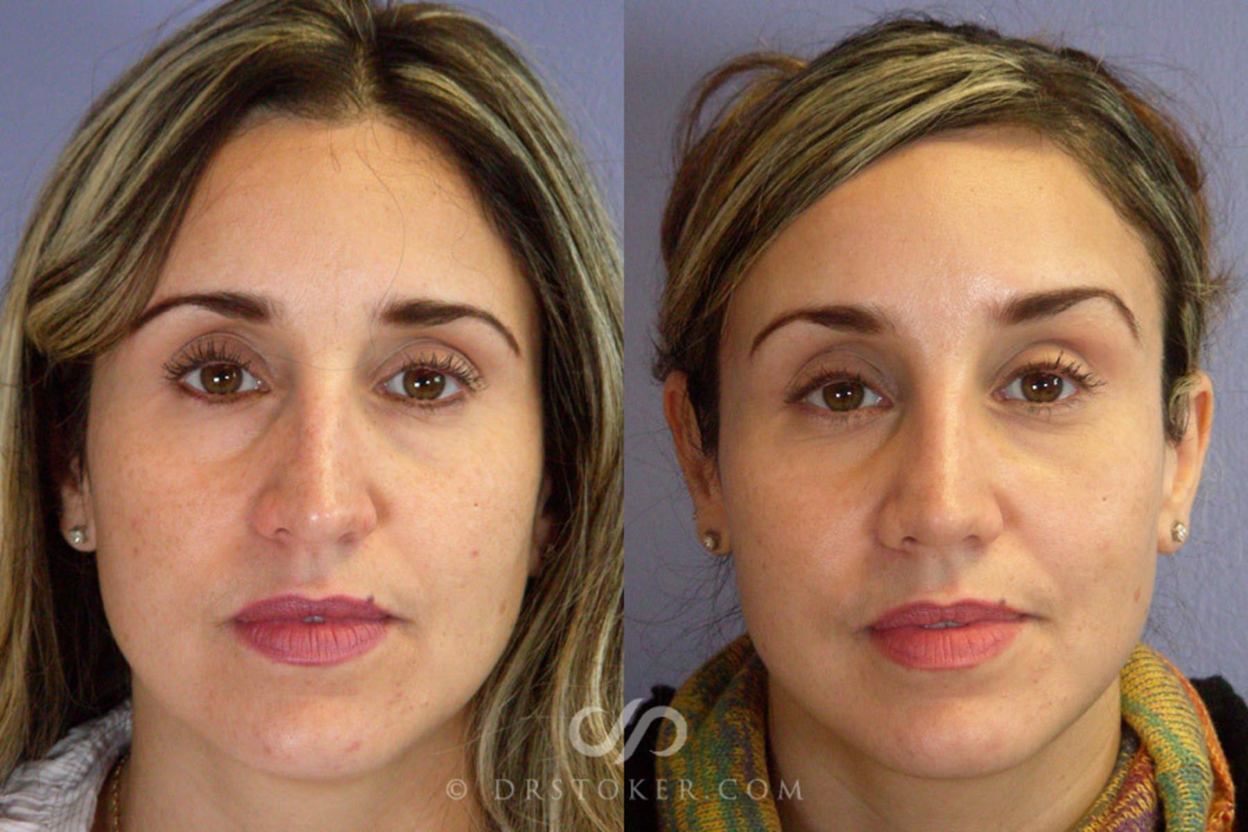 Before & After Rhinoplasty Case 292 View #1 View in Los Angeles, CA