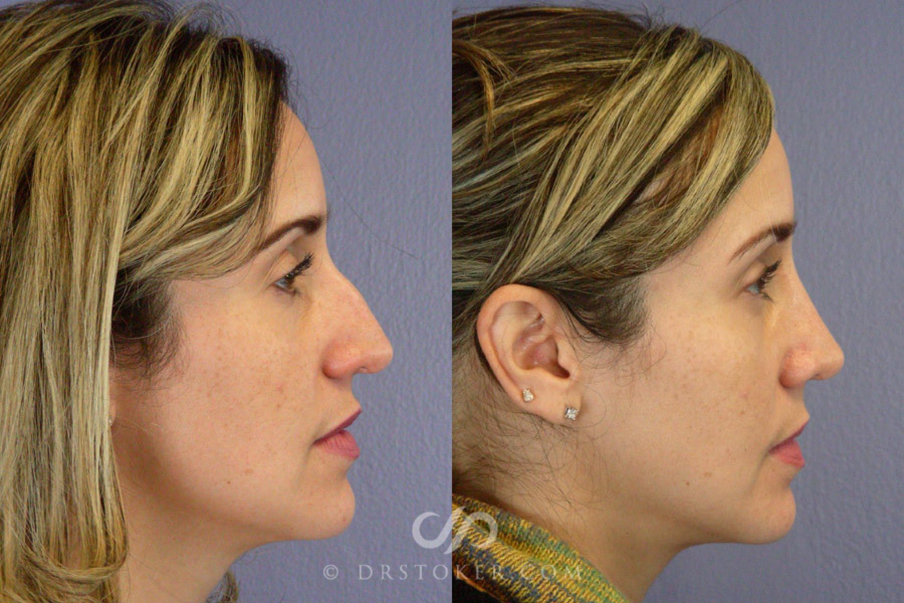Before & After Rhinoplasty Case 292 View #2 View in Los Angeles, CA