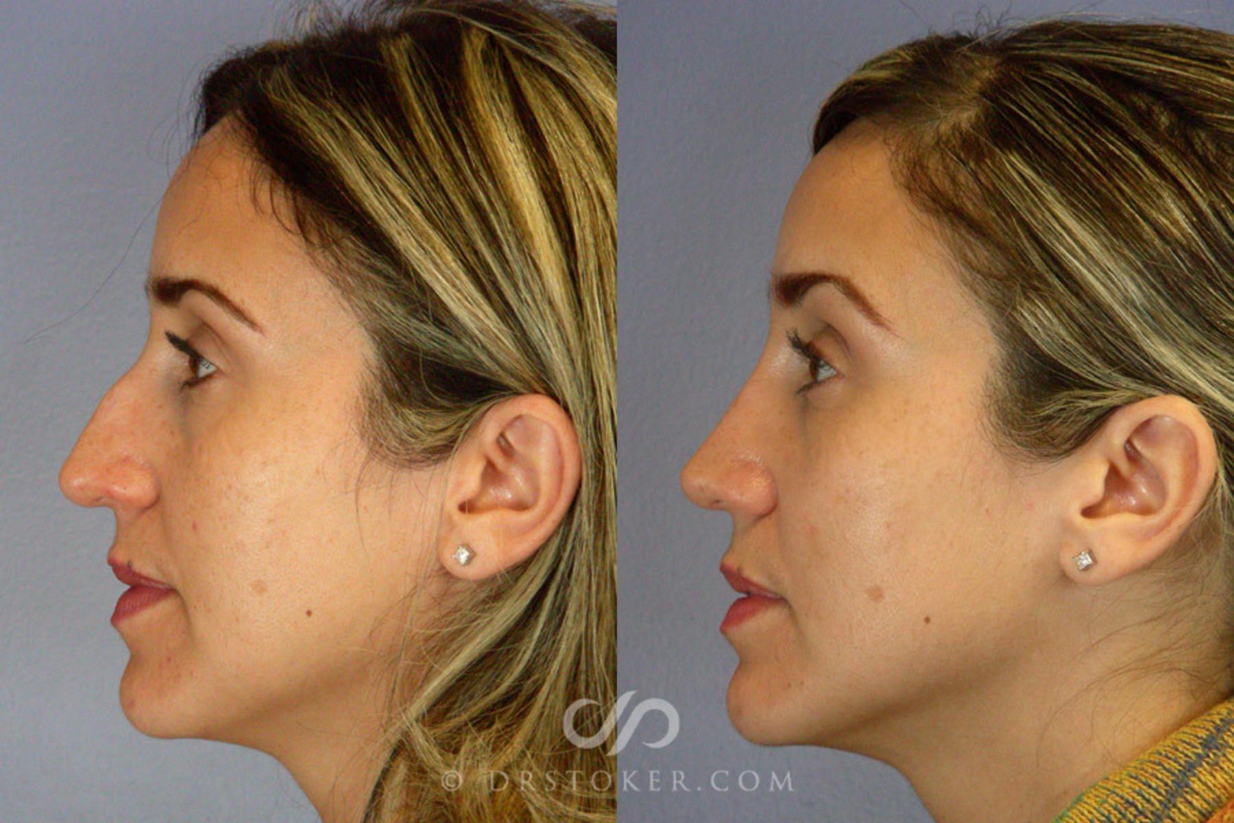 Before & After Rhinoplasty Case 292 View #3 View in Los Angeles, CA