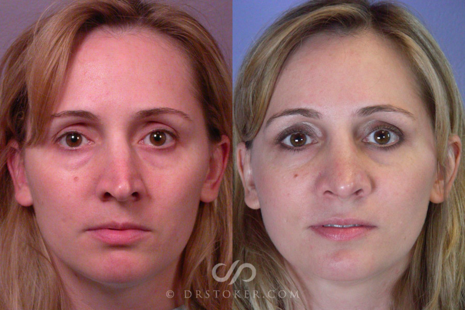 Before & After Rhinoplasty Case 293 View #1 View in Los Angeles, CA