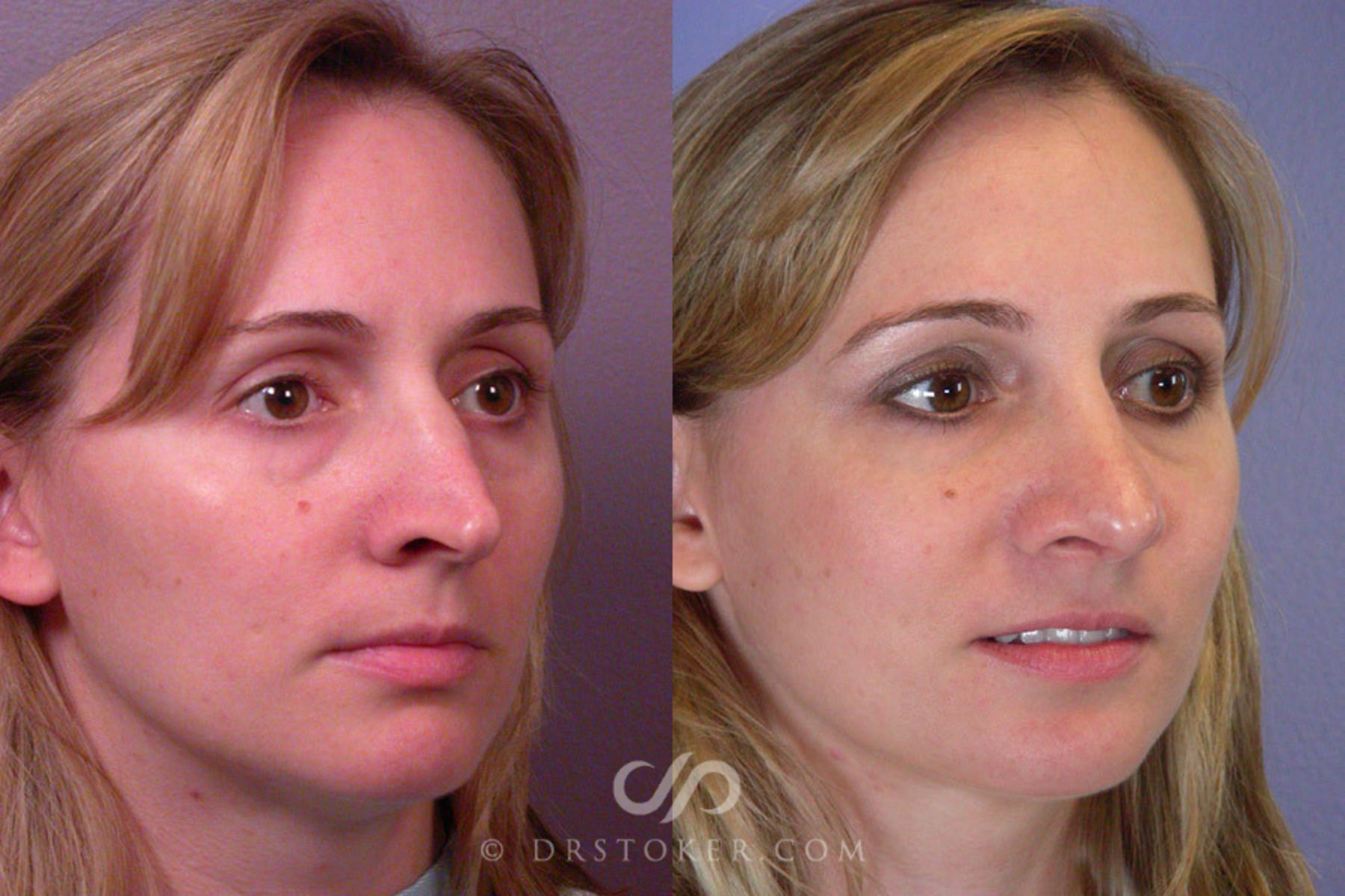 Before & After Rhinoplasty Case 293 View #2 View in Los Angeles, CA