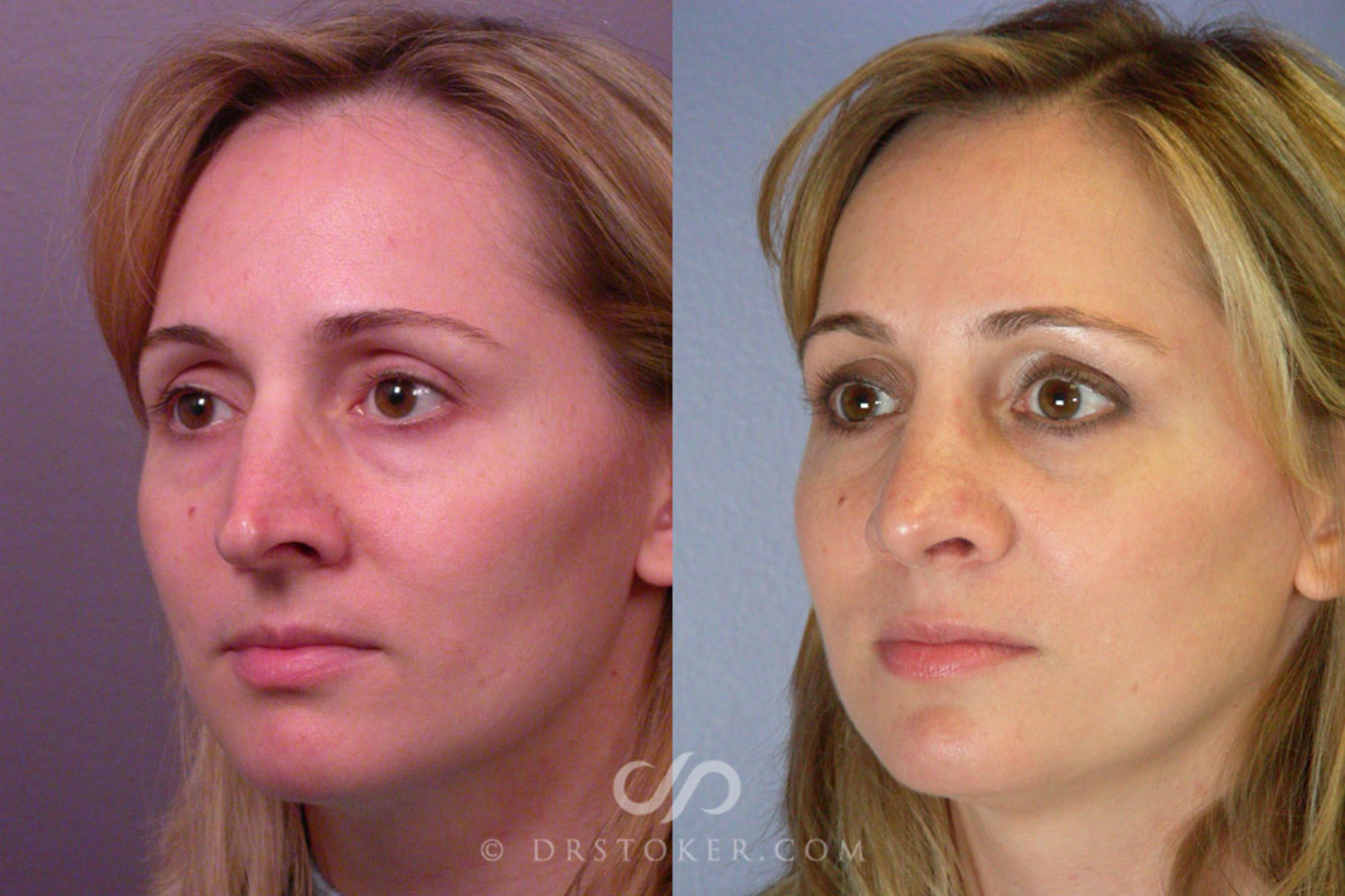 Before & After Rhinoplasty Case 293 View #3 View in Los Angeles, CA