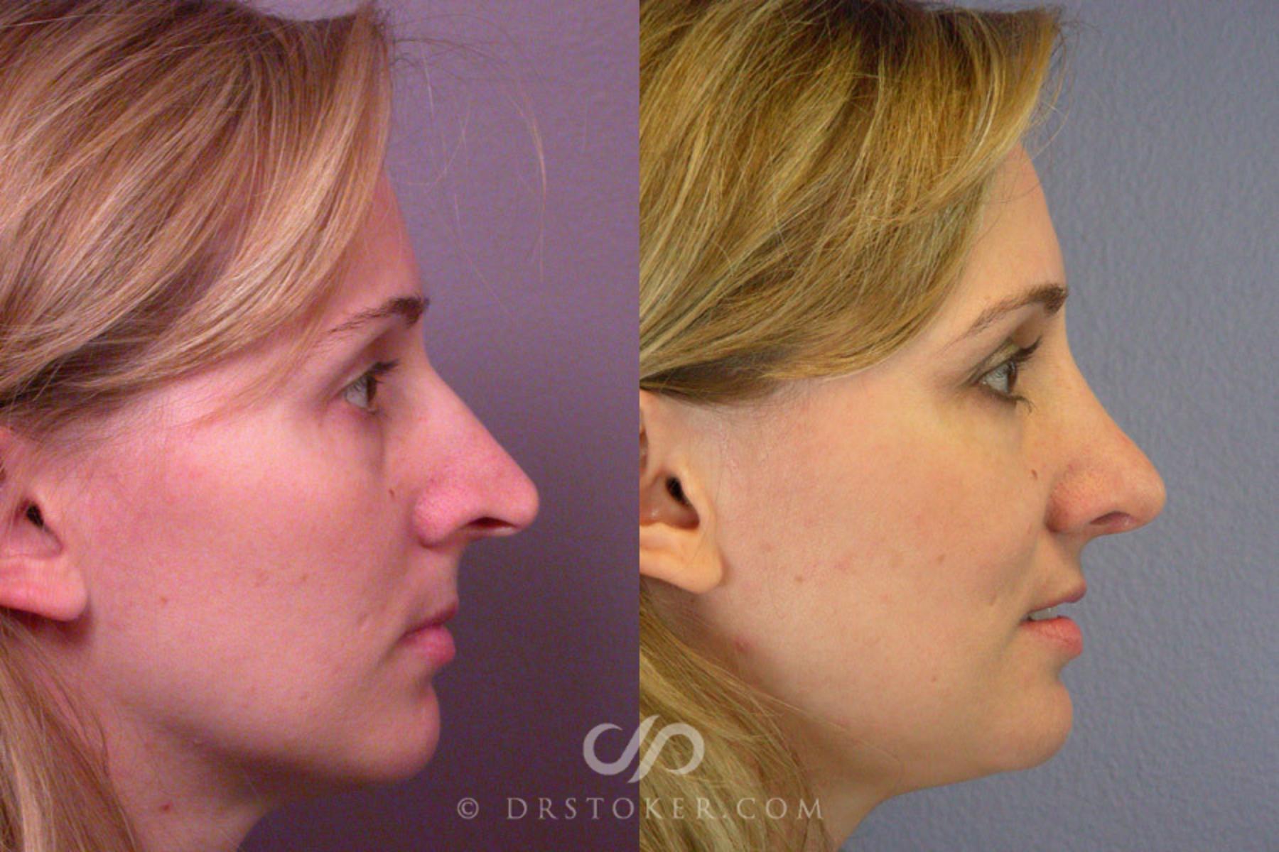 Before & After Rhinoplasty Case 293 View #4 View in Los Angeles, CA