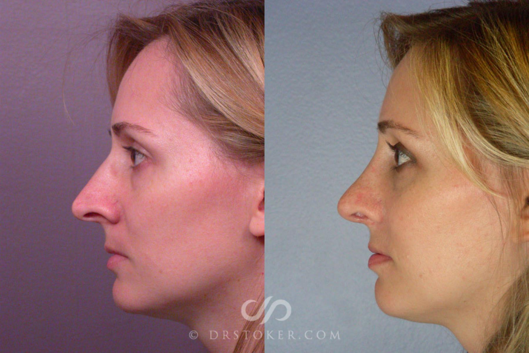 Before & After Rhinoplasty Case 293 View #5 View in Los Angeles, CA